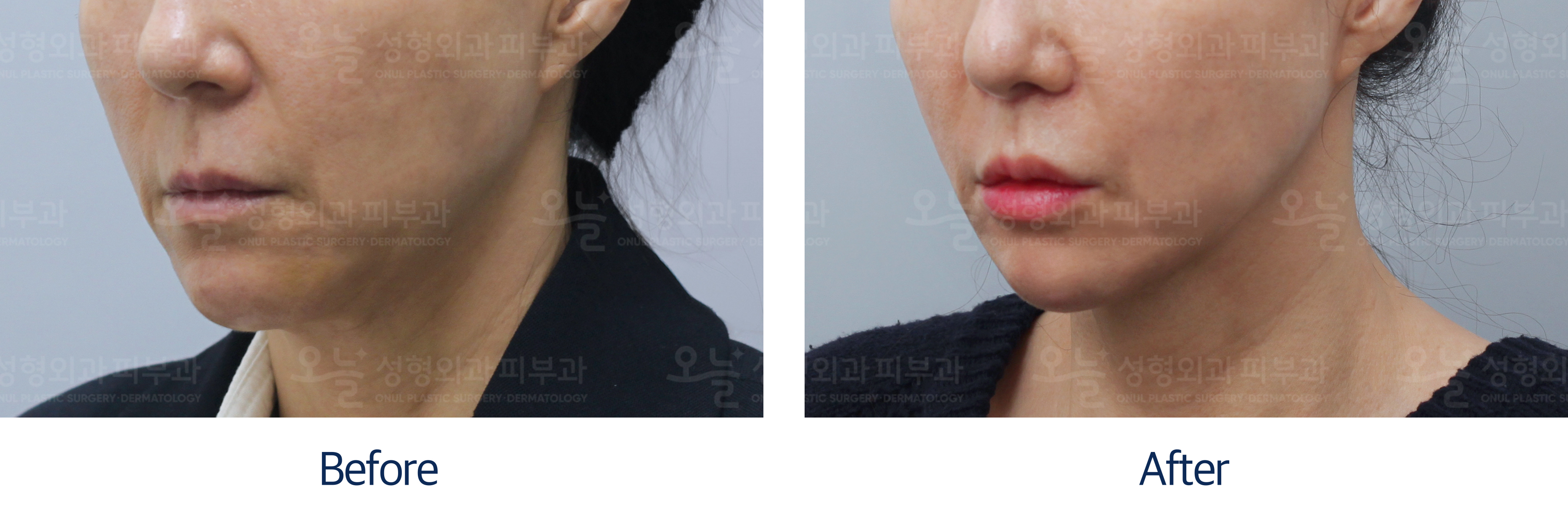 오늘성형외과 전후사진