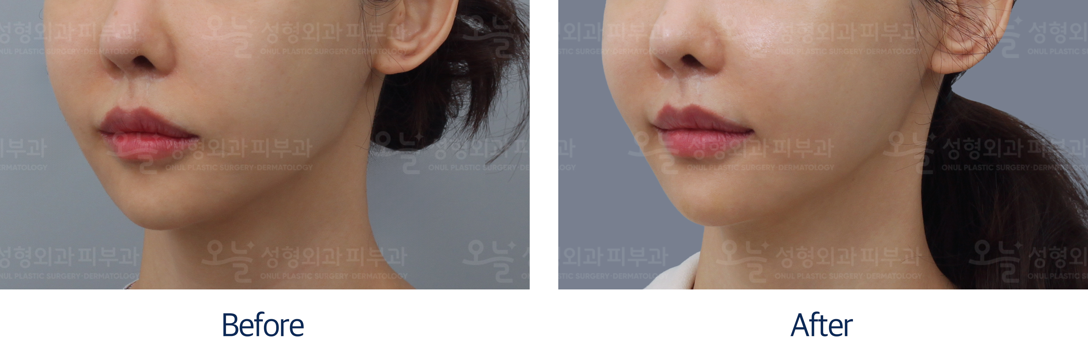 오늘성형외과 전후사진