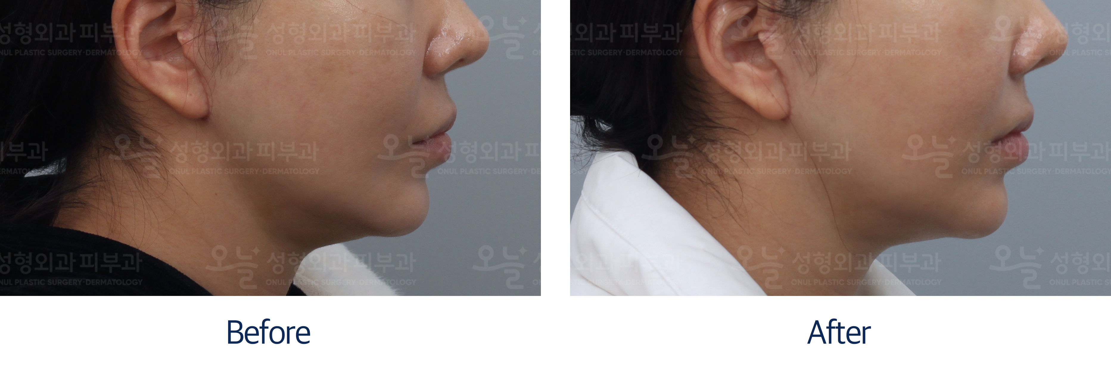 오늘성형외과 전후사진