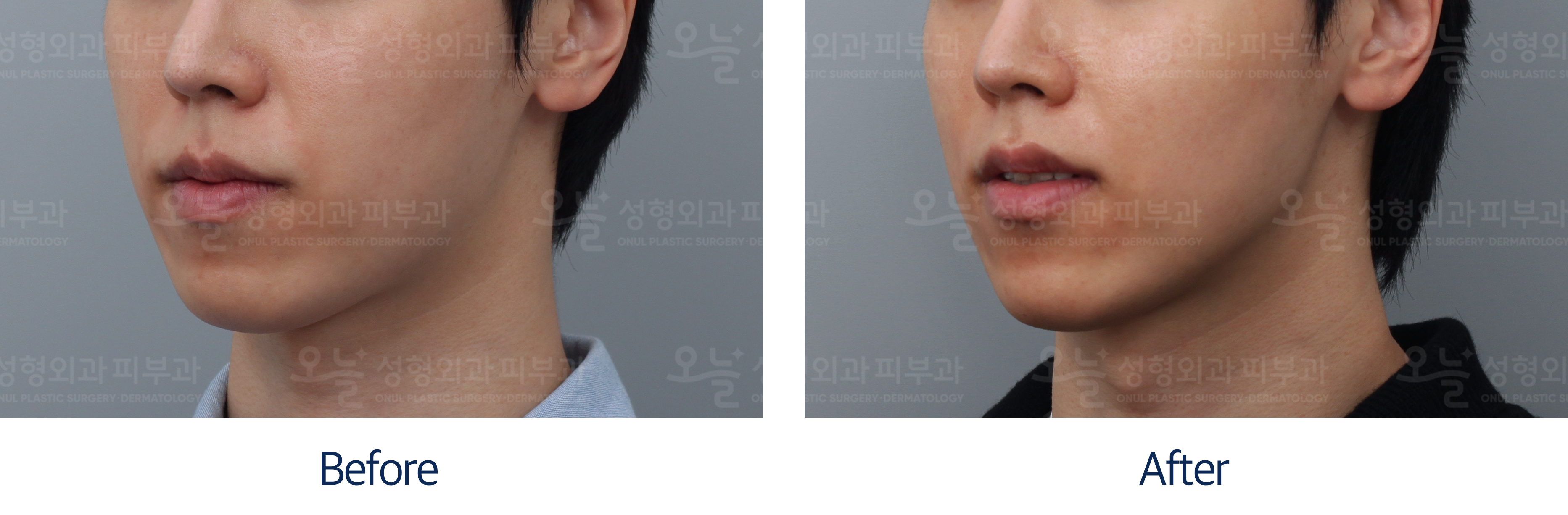 오늘성형외과 전후사진