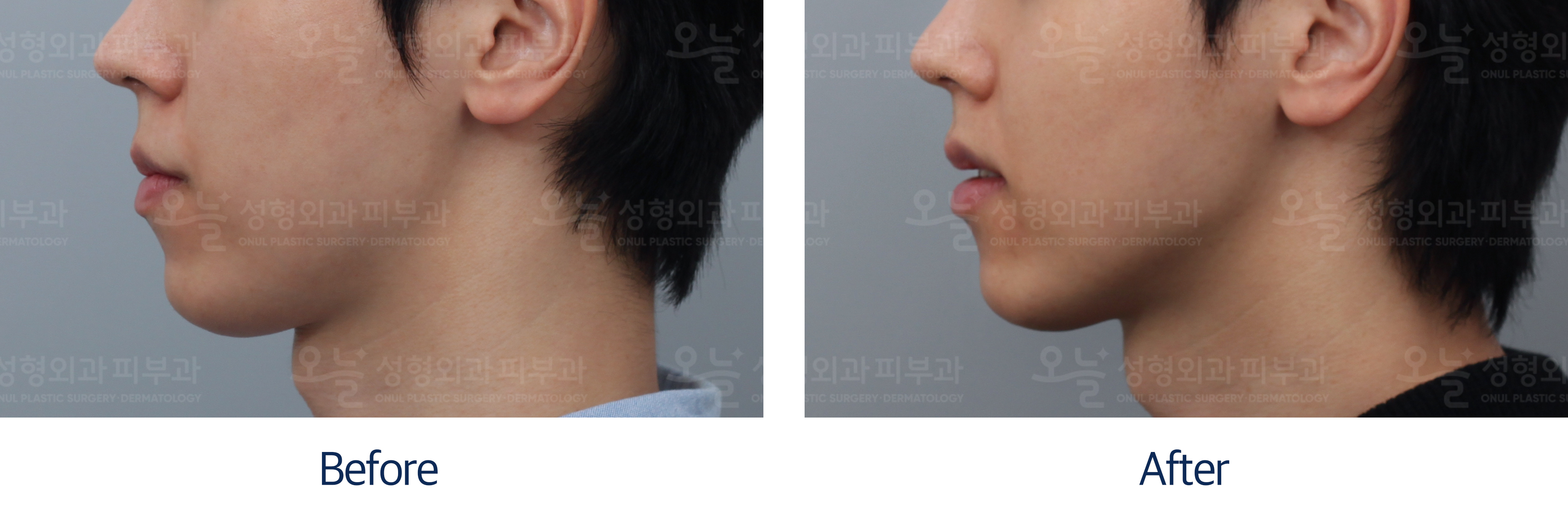 오늘성형외과 전후사진