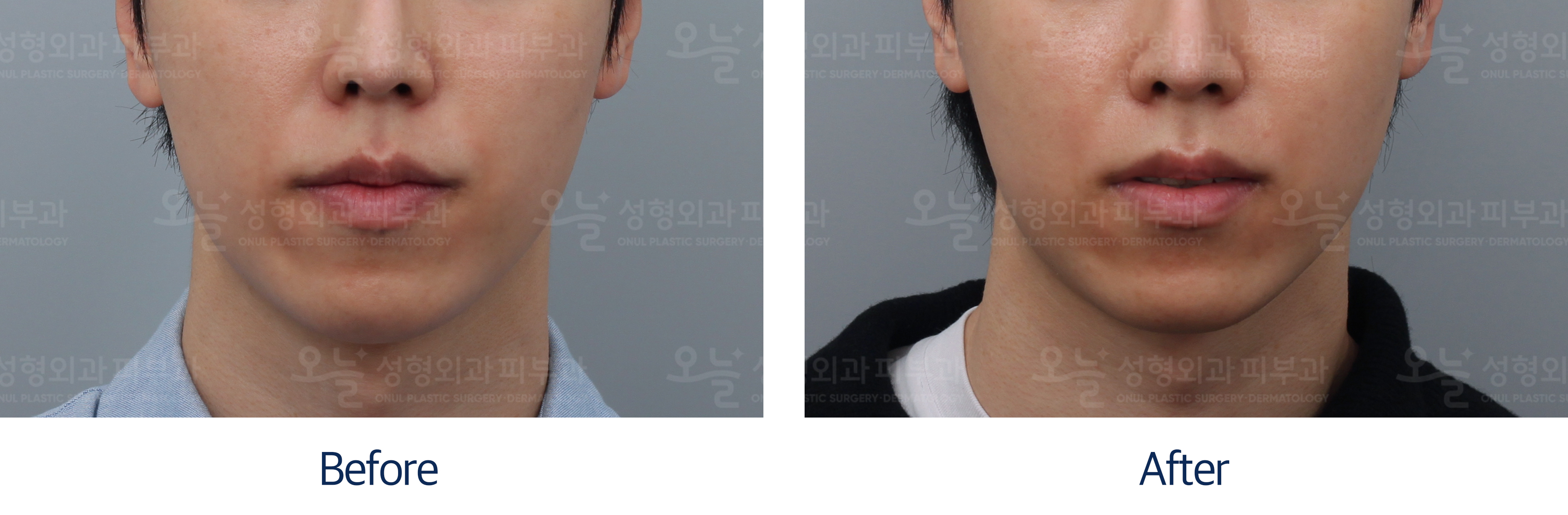 오늘성형외과 전후사진