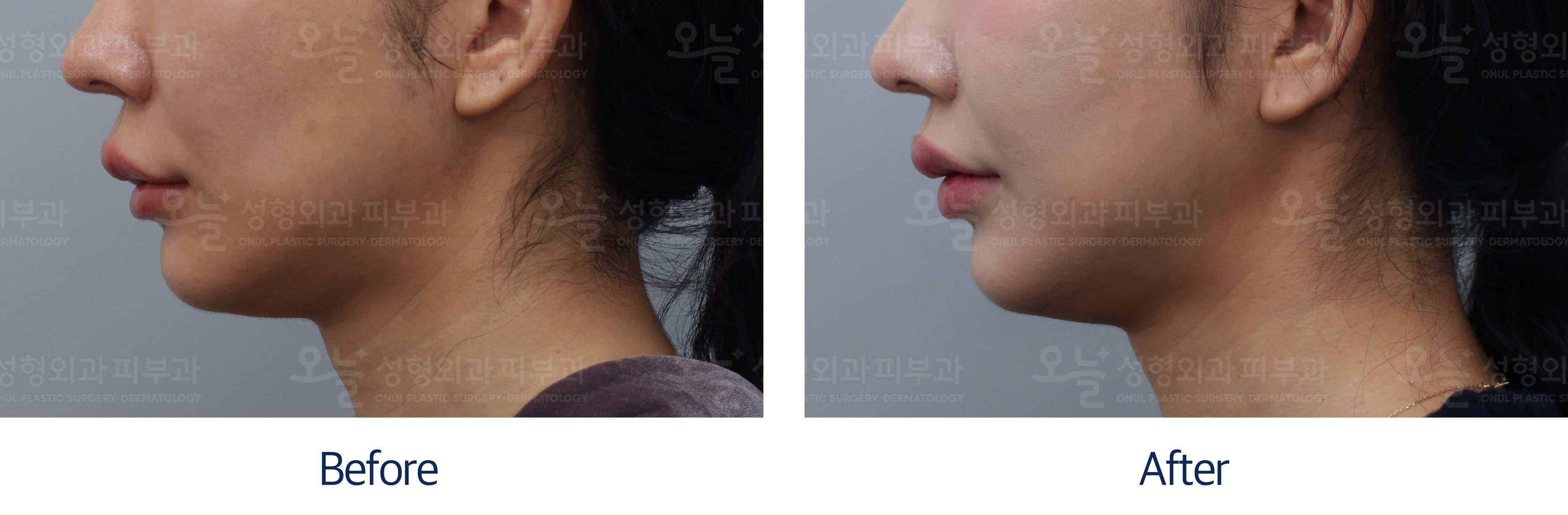 오늘성형외과 전후사진