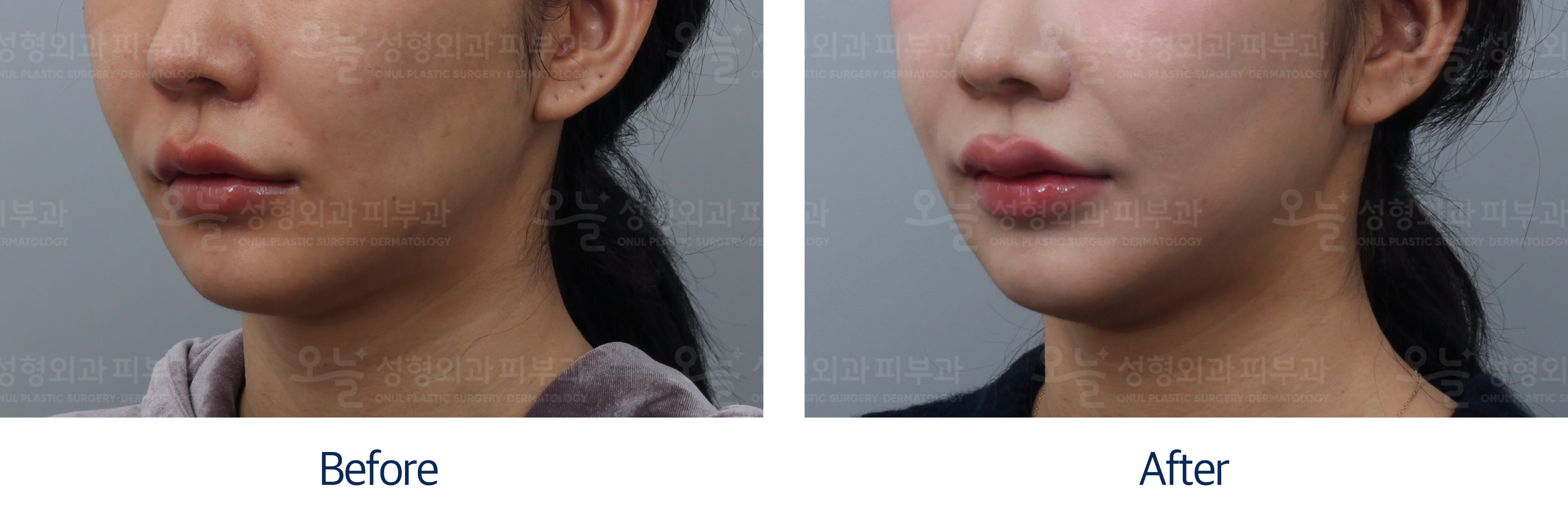 오늘성형외과 전후사진
