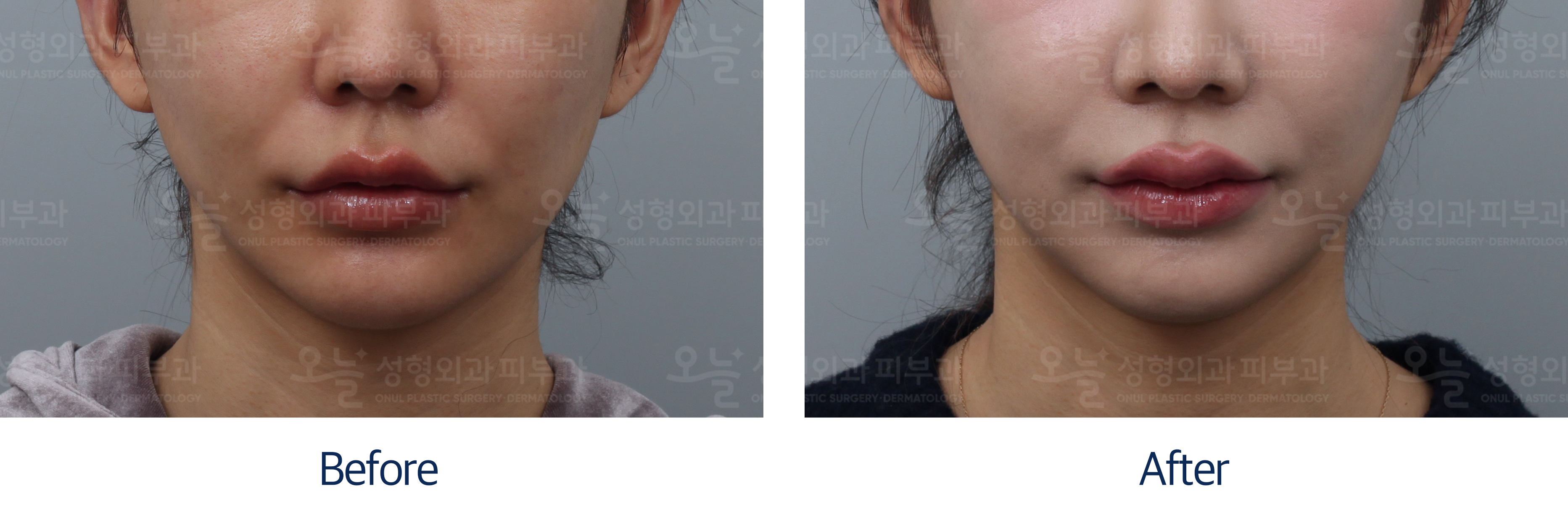 오늘성형외과 전후사진