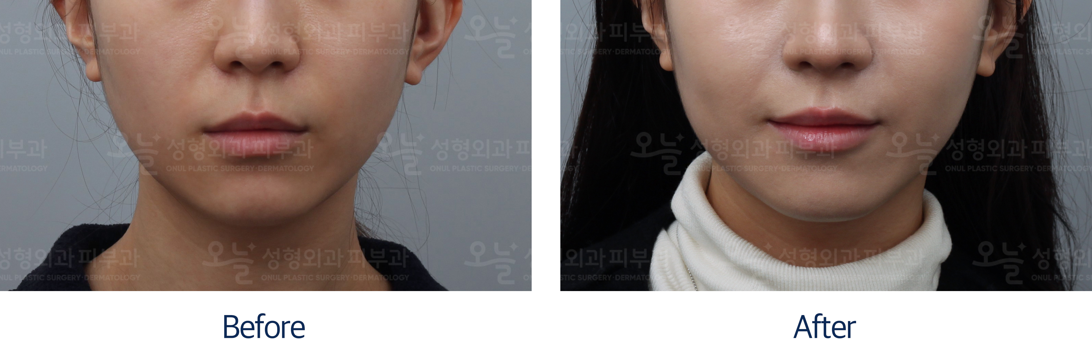 오늘성형외과 전후사진