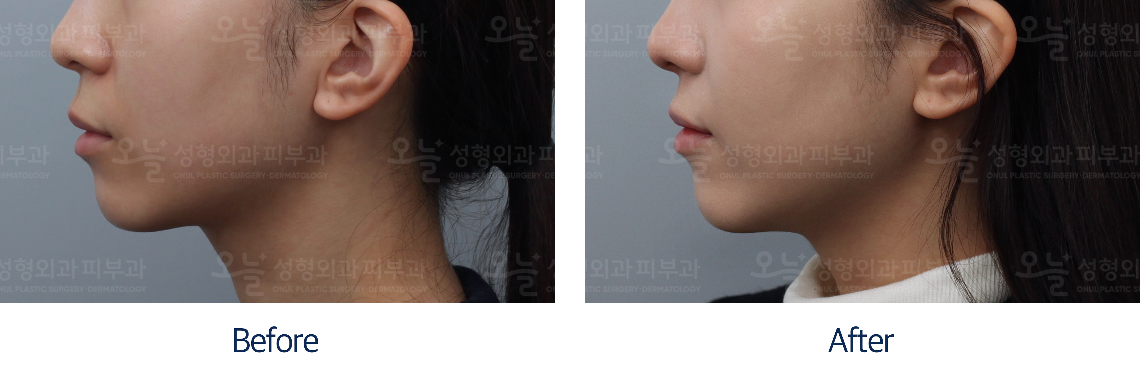 오늘성형외과 전후사진