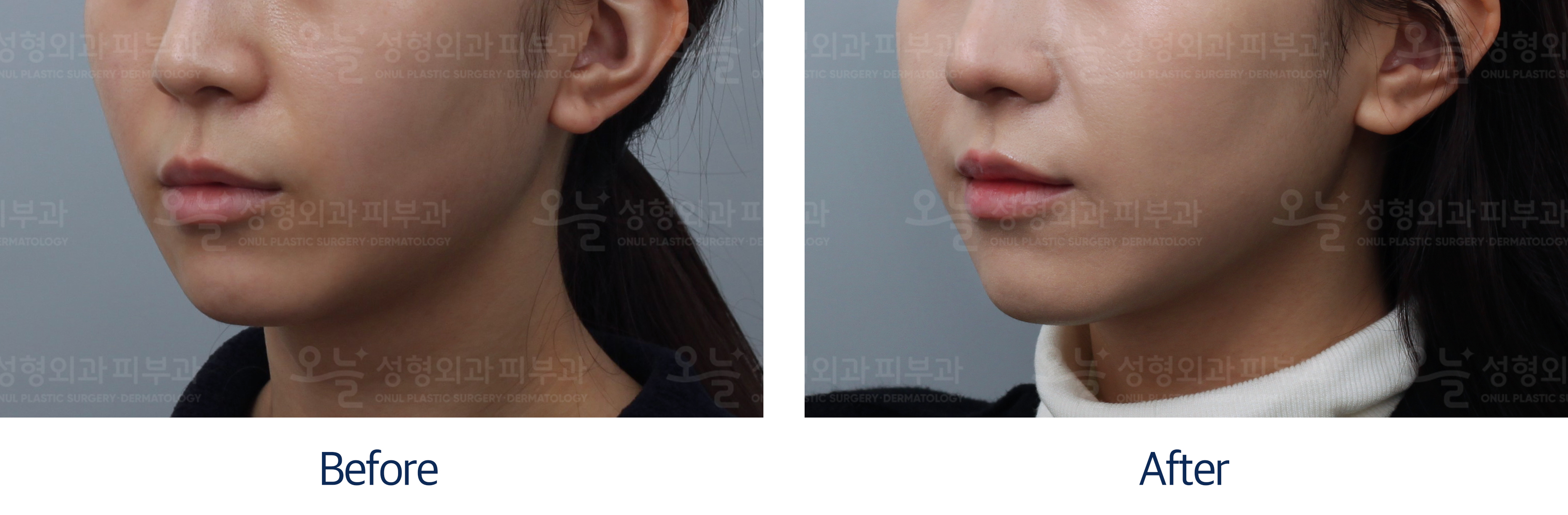 오늘성형외과 전후사진