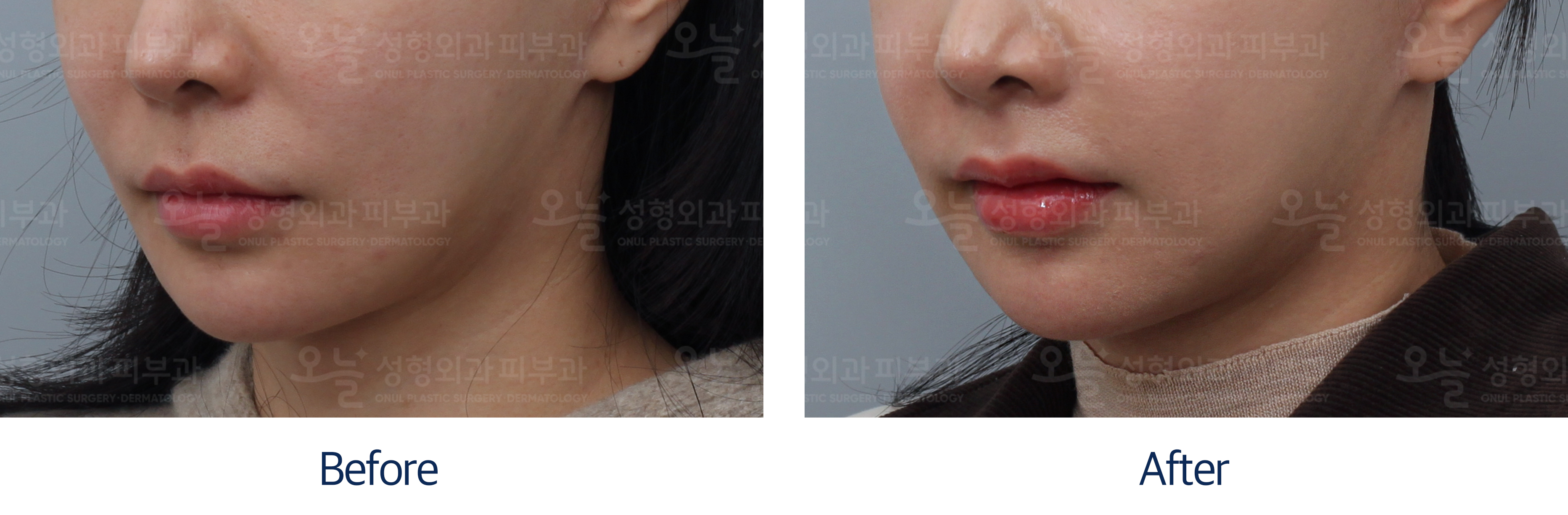 오늘성형외과 전후사진