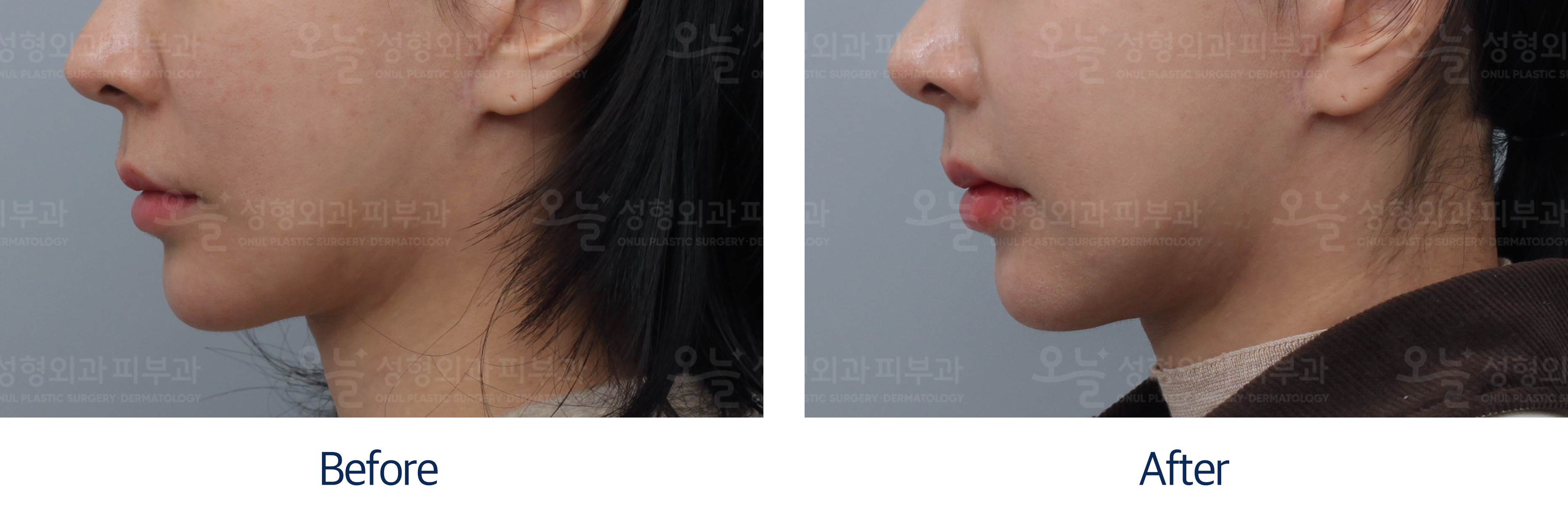 오늘성형외과 전후사진