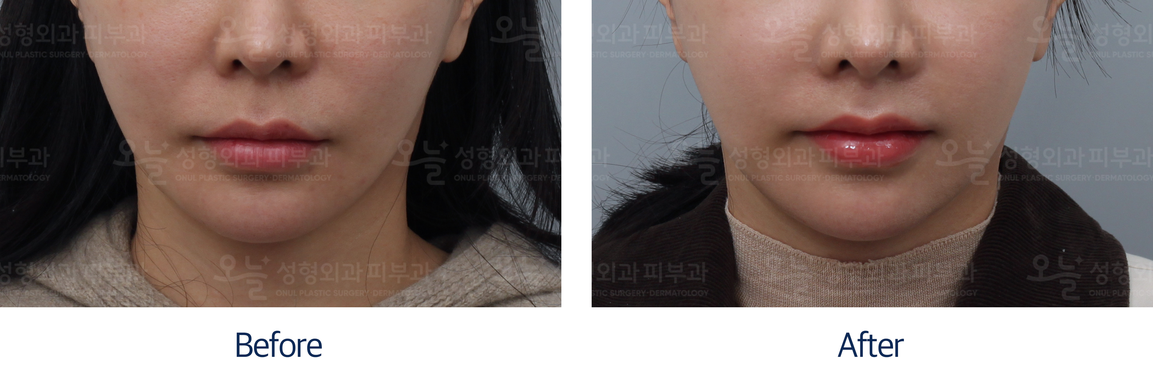 오늘성형외과 전후사진