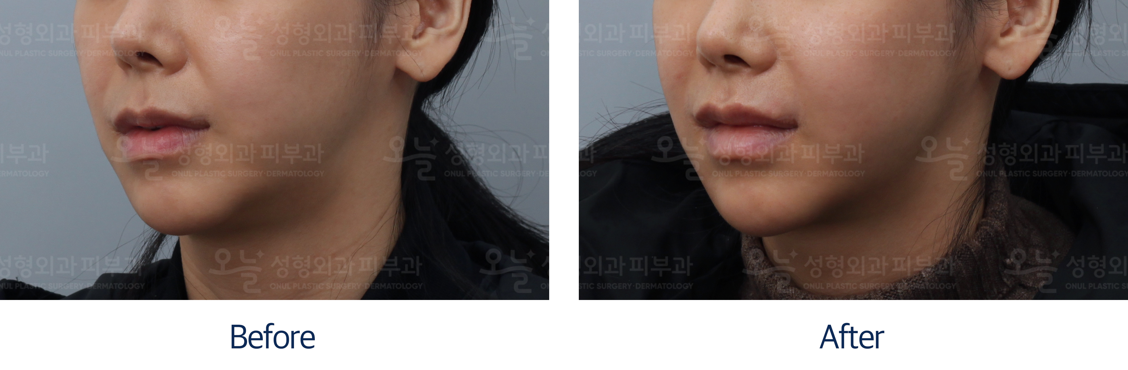 오늘성형외과 전후사진