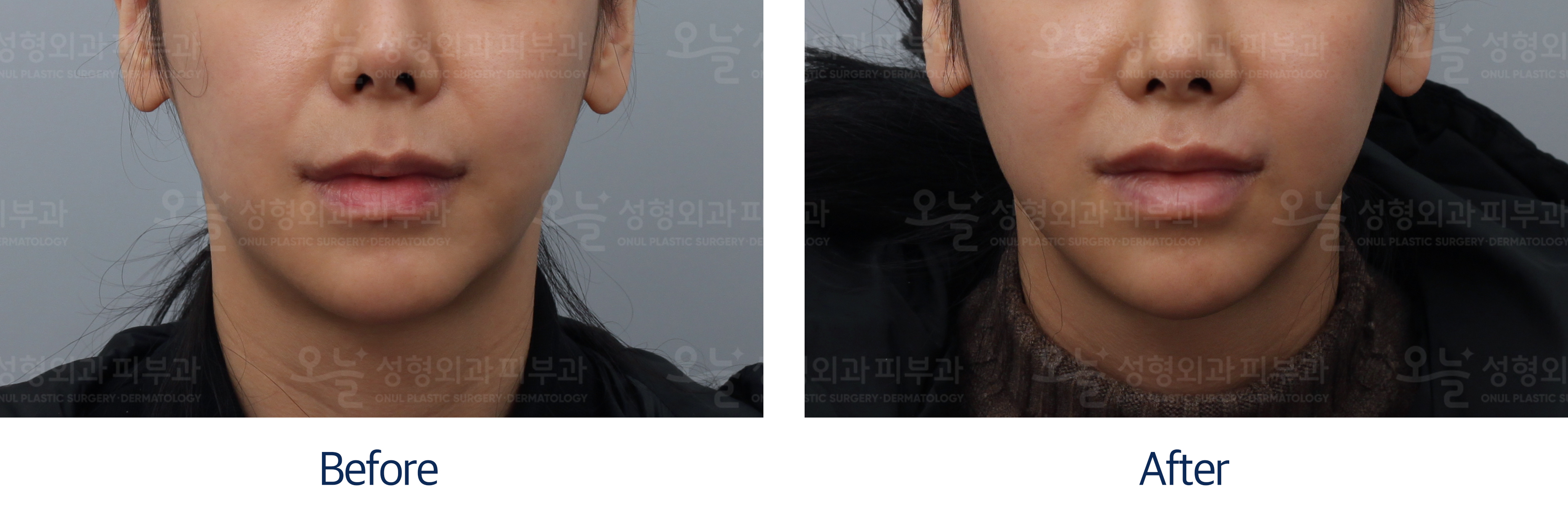 오늘성형외과 전후사진