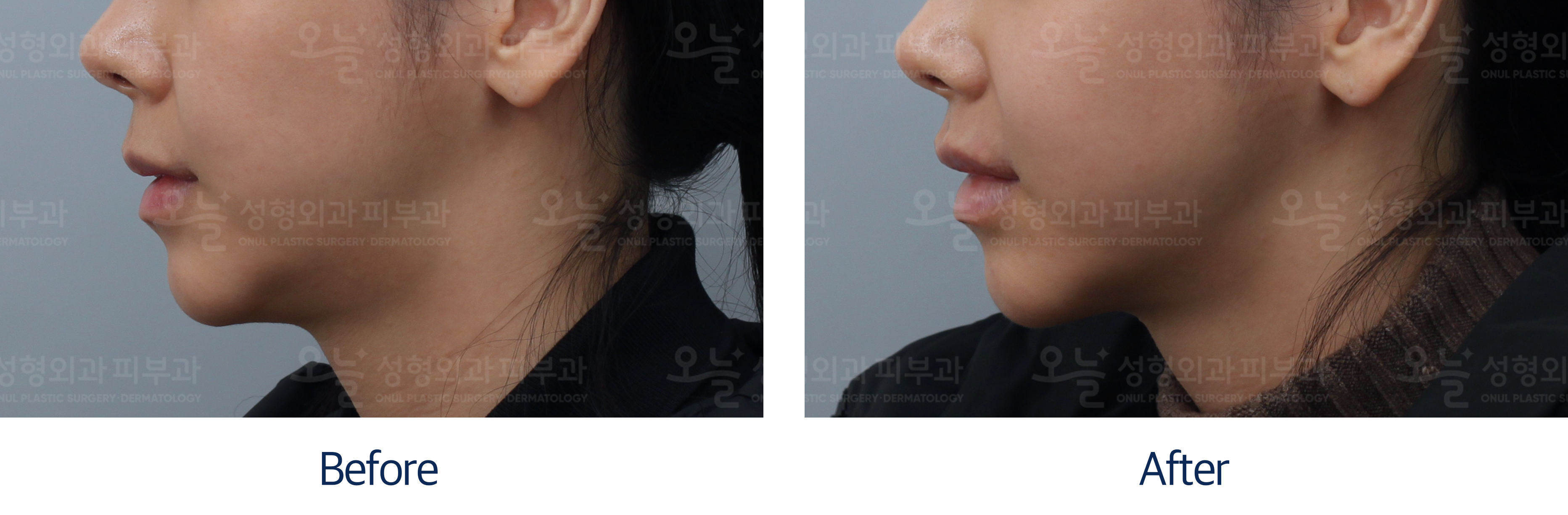 오늘성형외과 전후사진