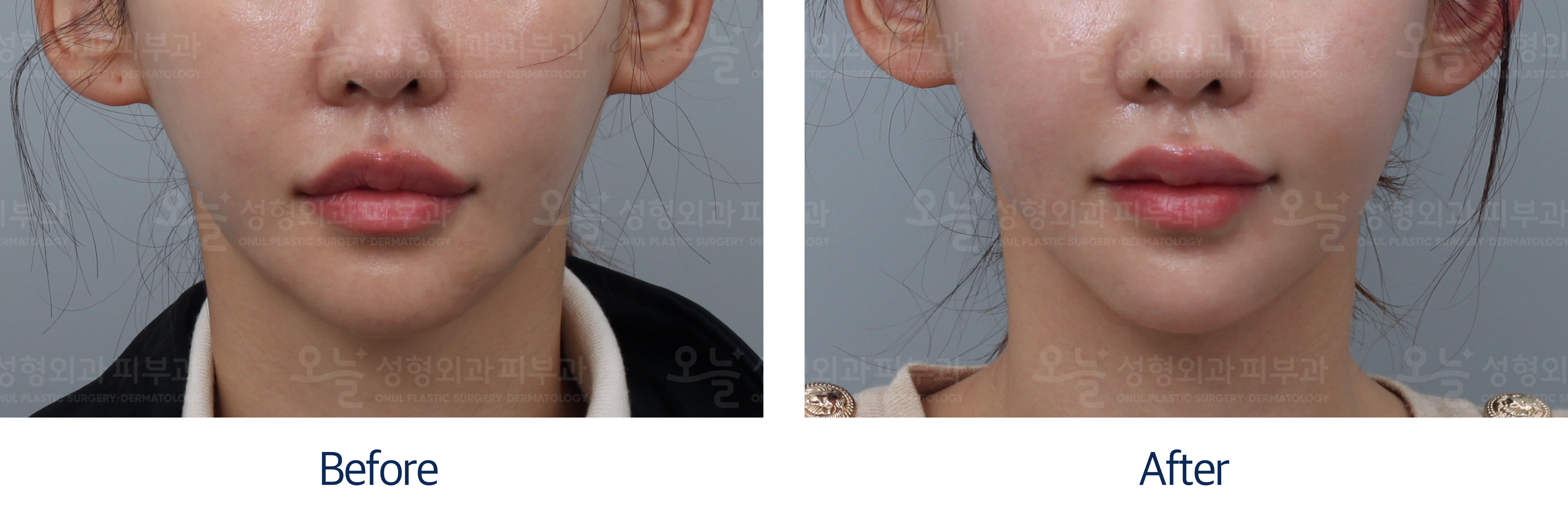 오늘성형외과 전후사진