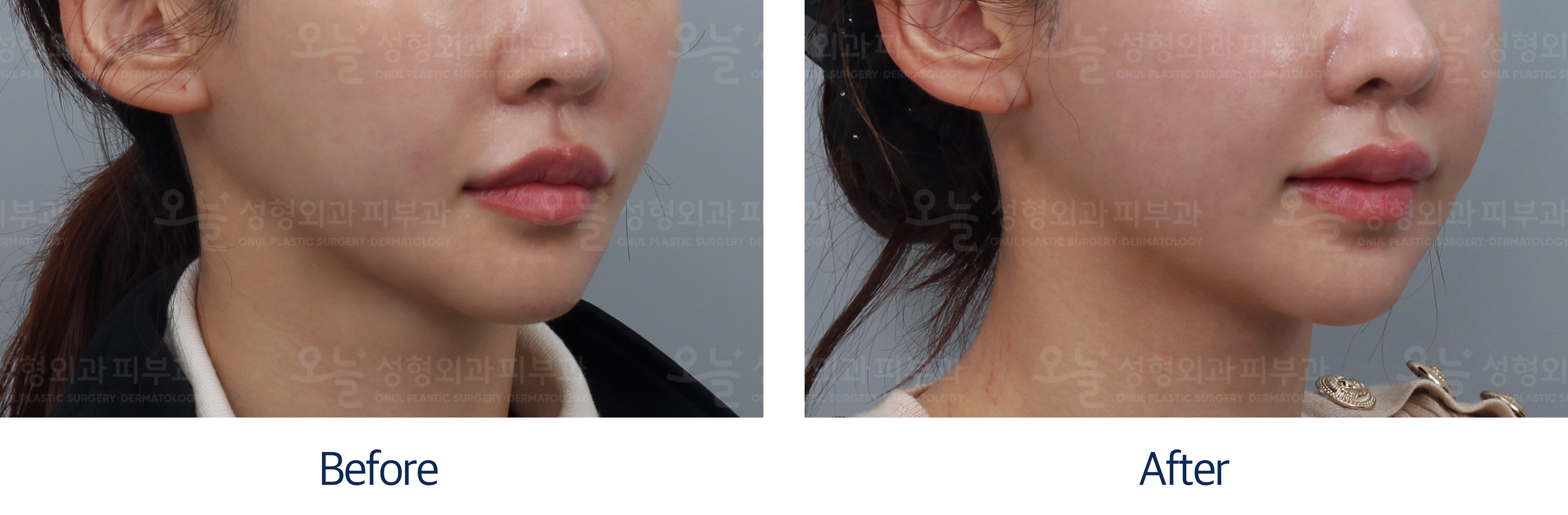 오늘성형외과 전후사진