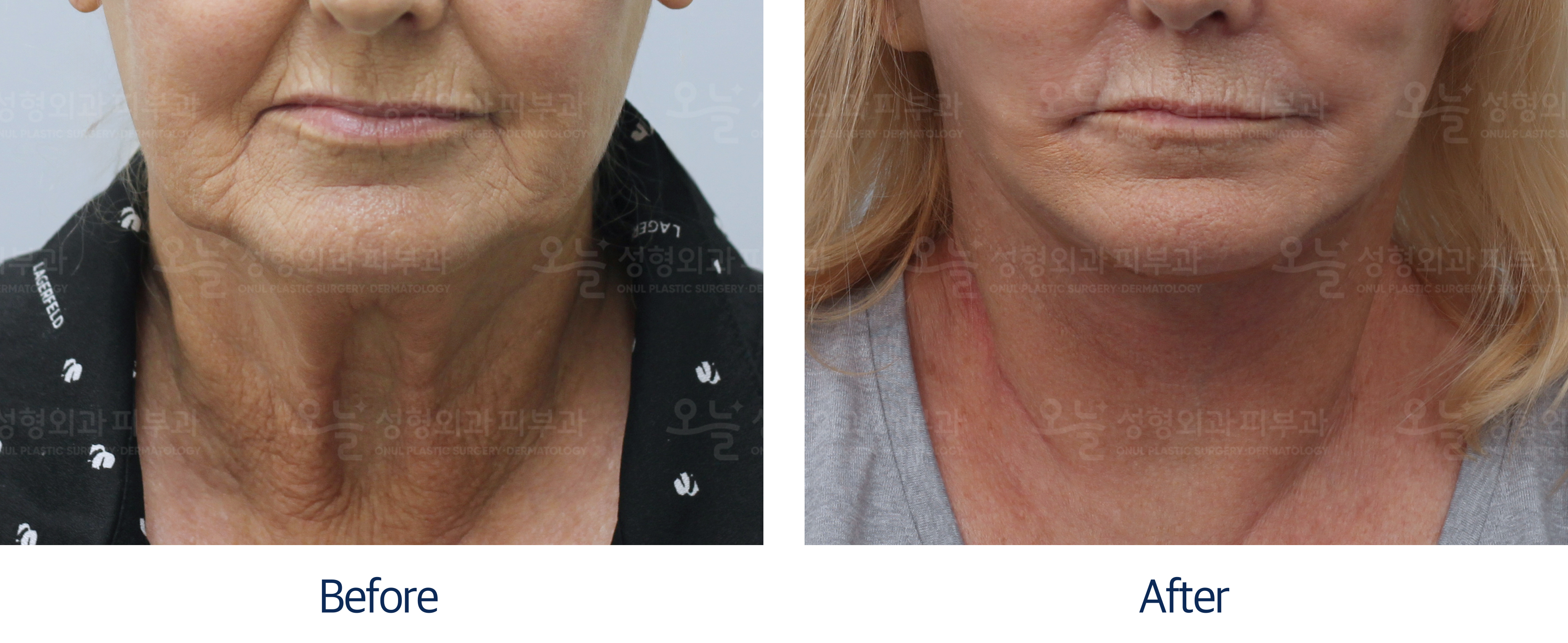 오늘성형외과 전후사진