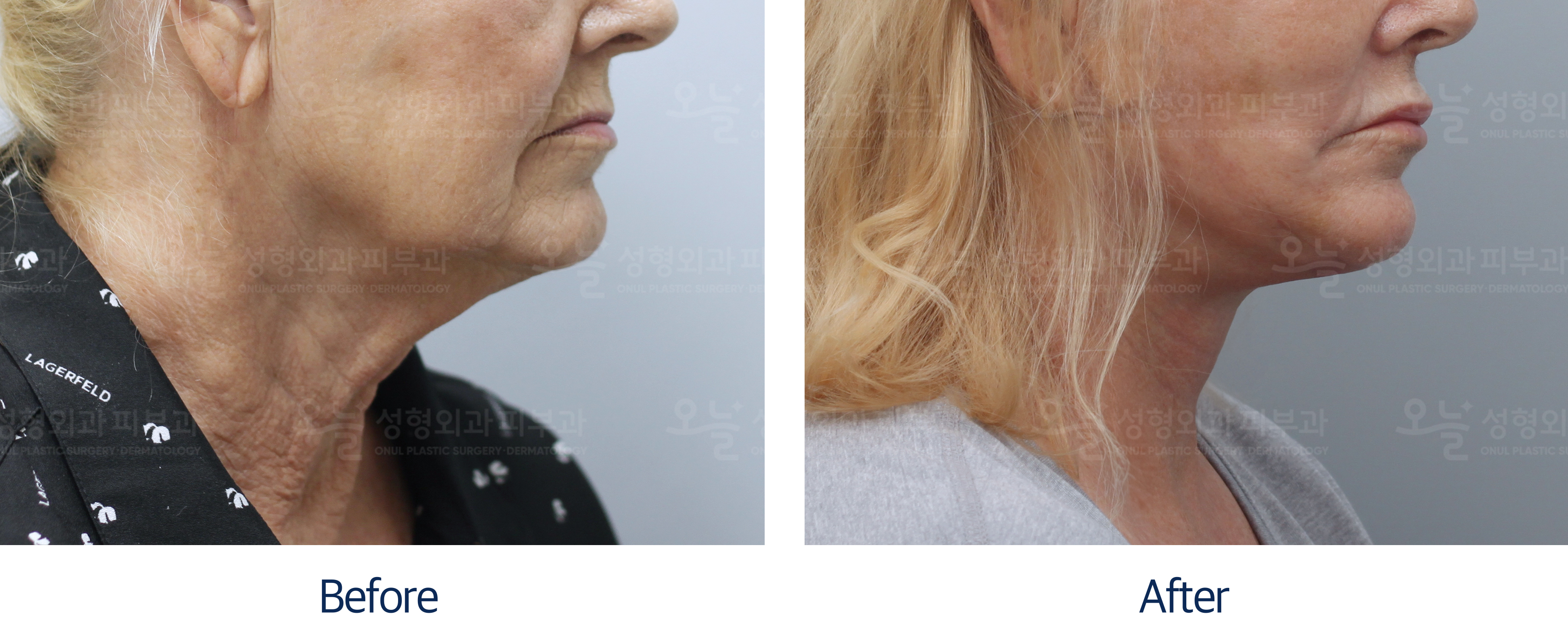 오늘성형외과 전후사진