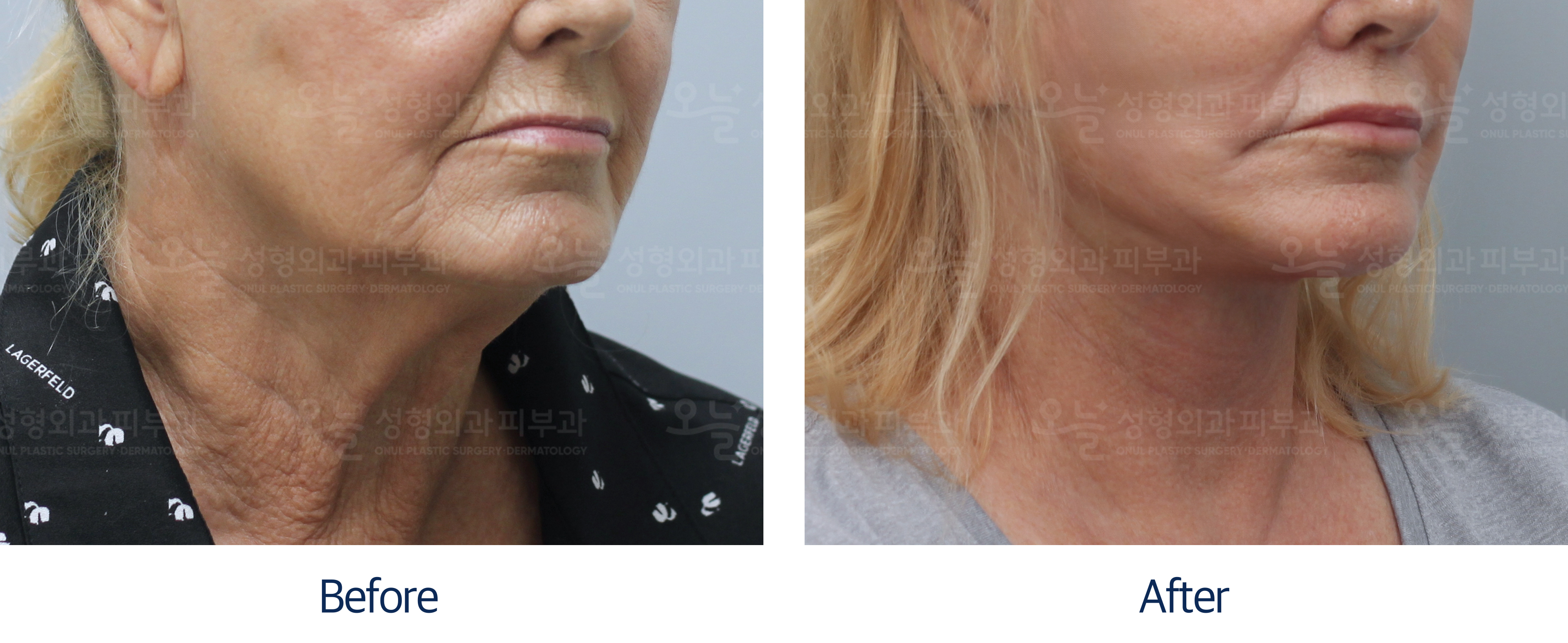 오늘성형외과 전후사진