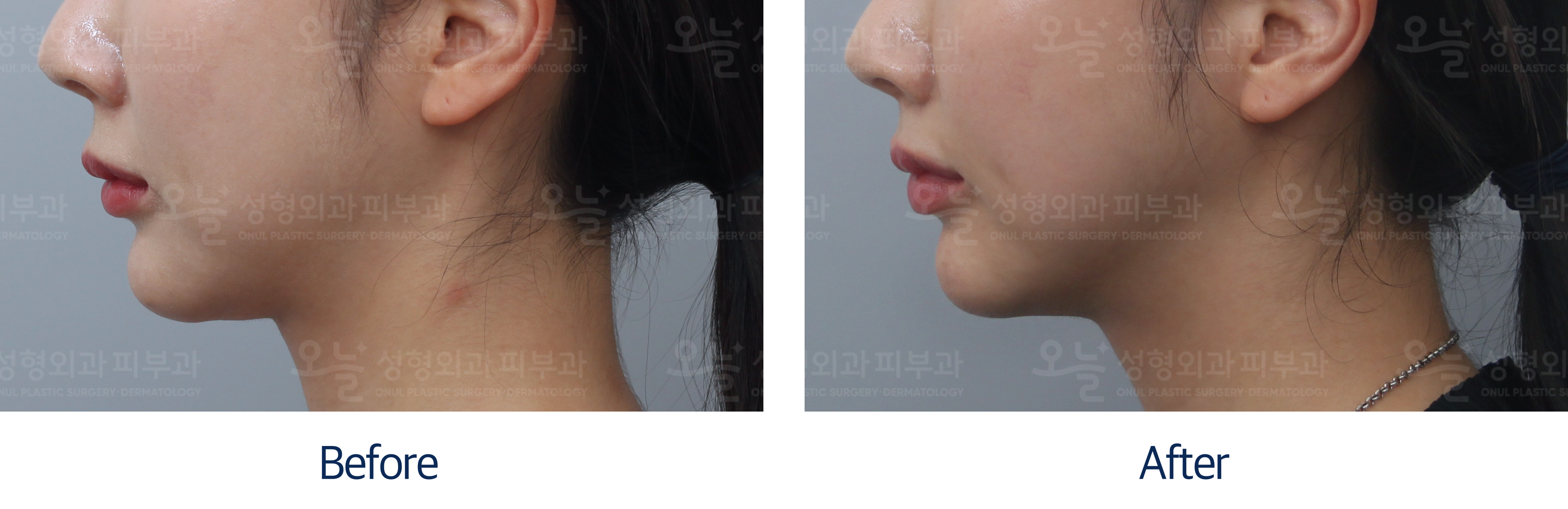 오늘성형외과 전후사진