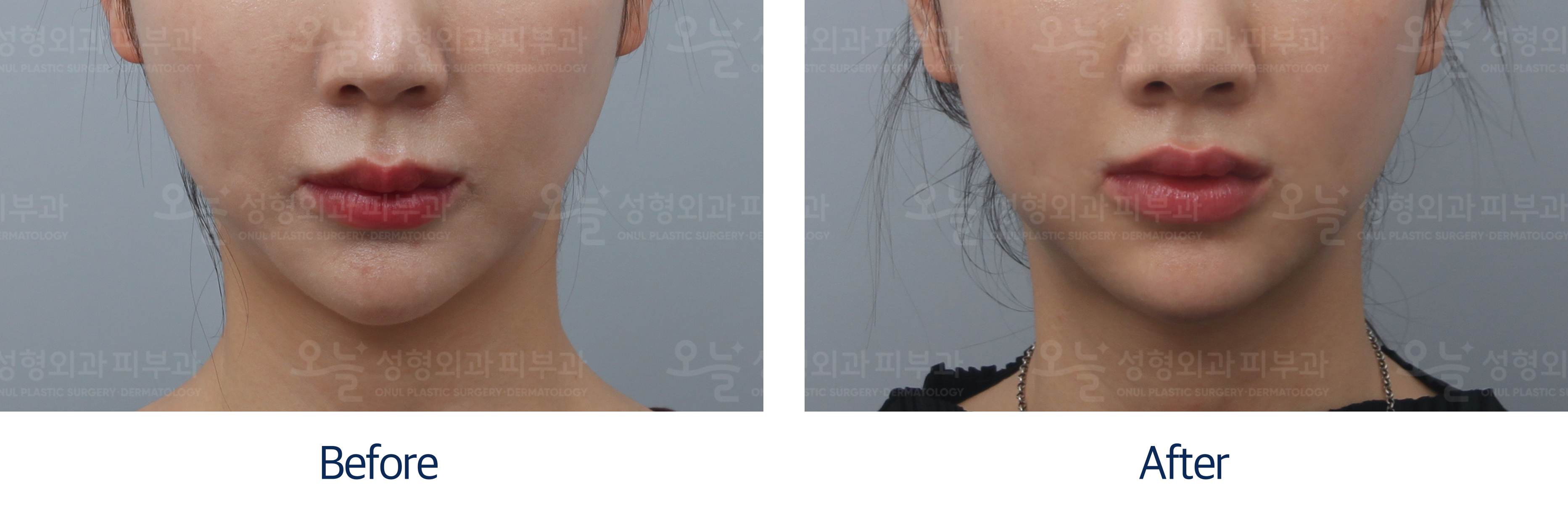 오늘성형외과 전후사진