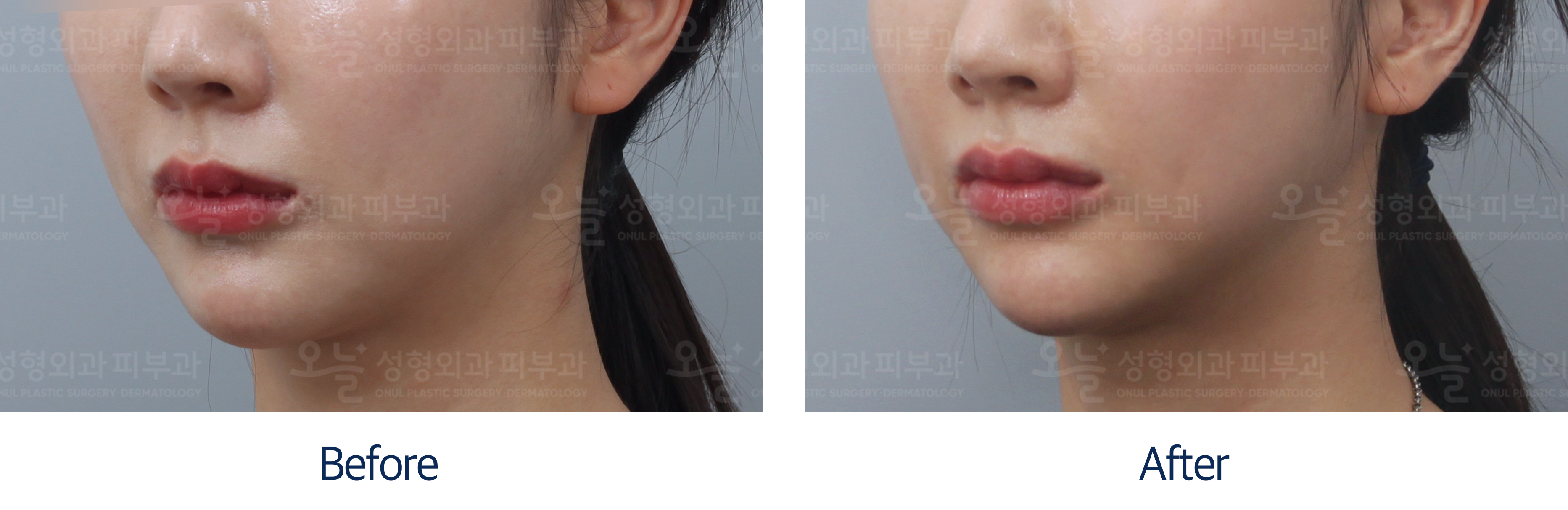 오늘성형외과 전후사진