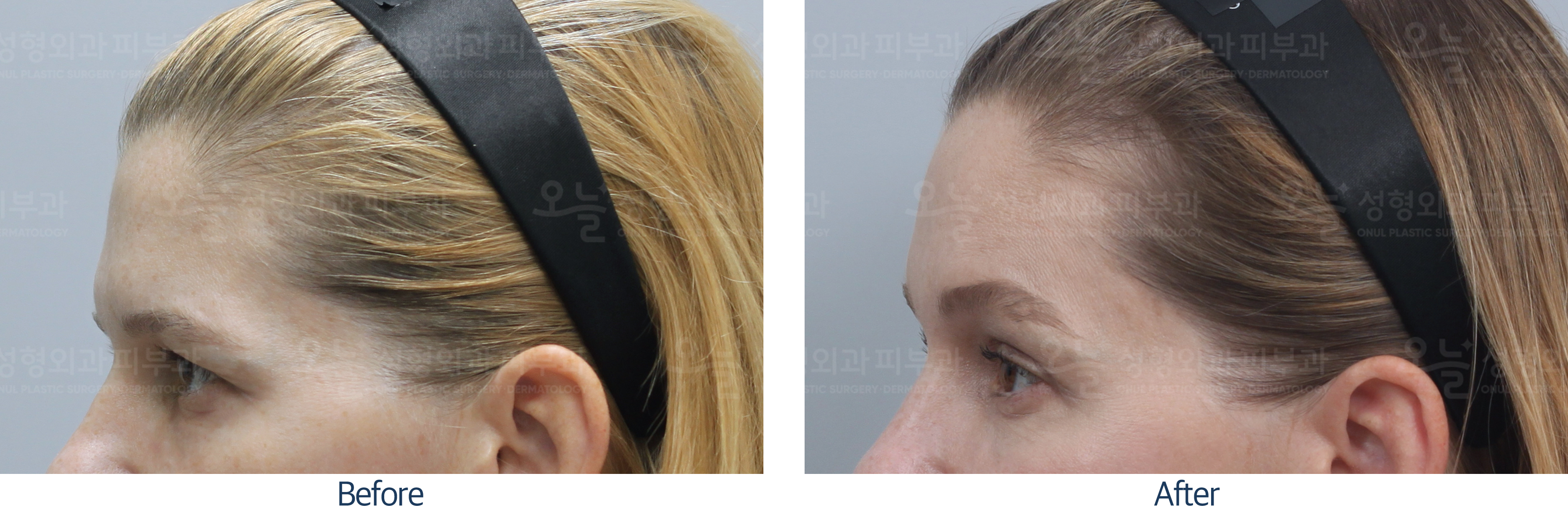 오늘성형외과 전후사진