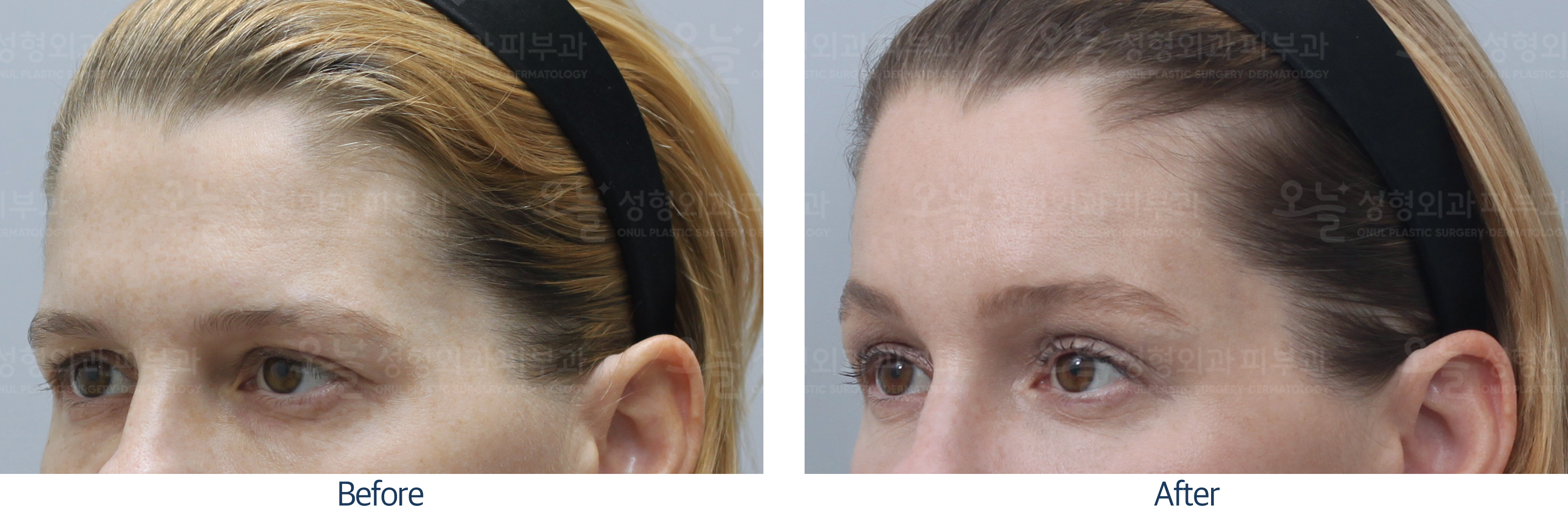 오늘성형외과 전후사진