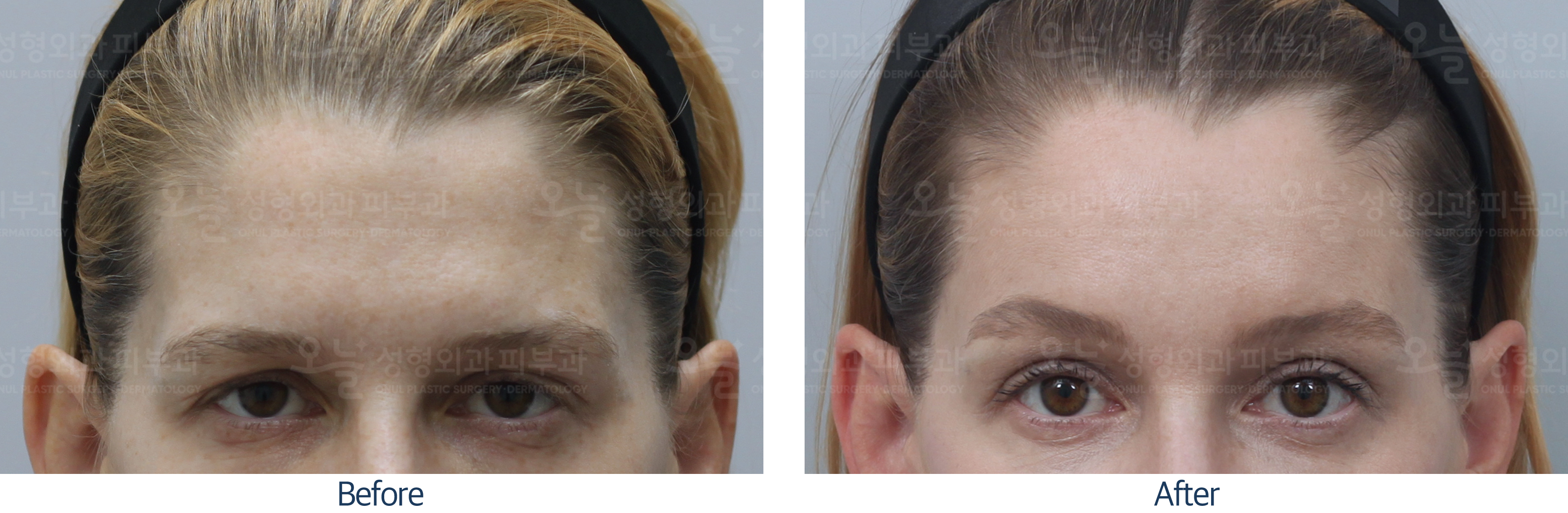 오늘성형외과 전후사진