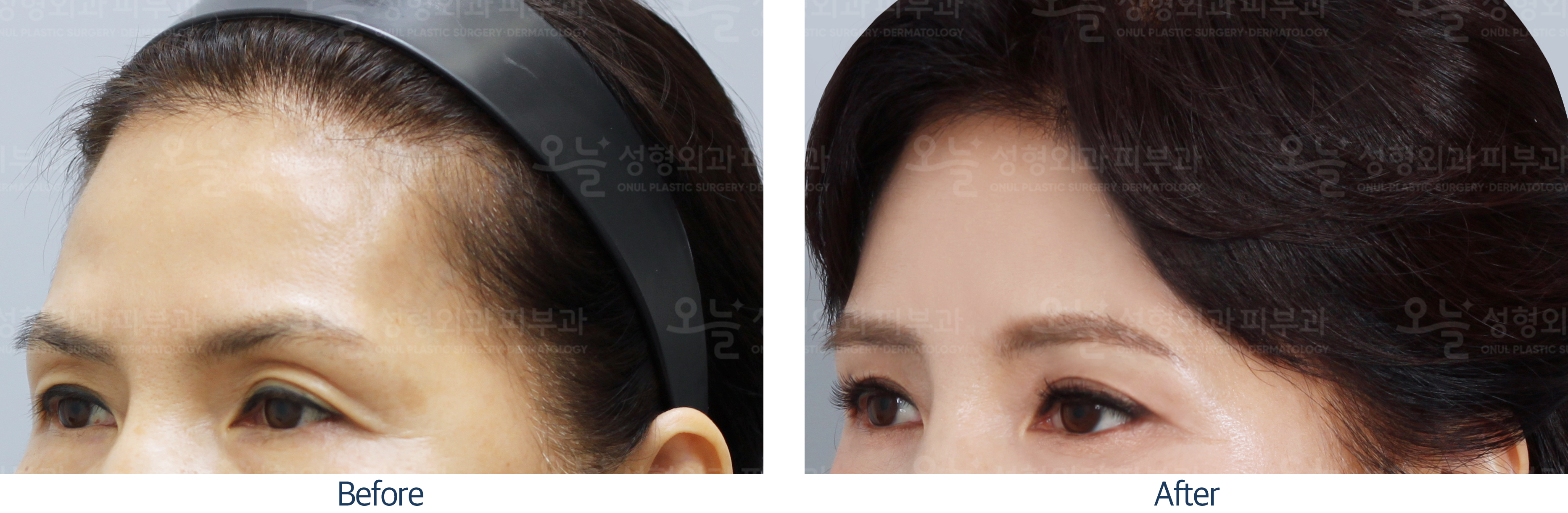 오늘성형외과 전후사진