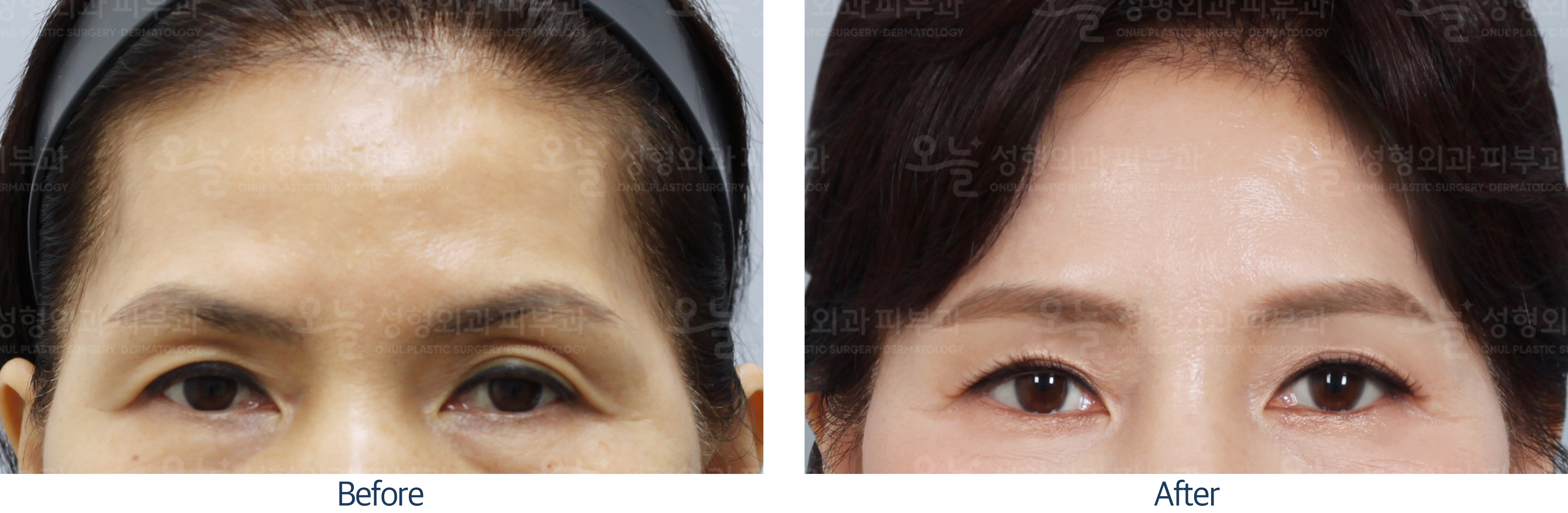 오늘성형외과 전후사진