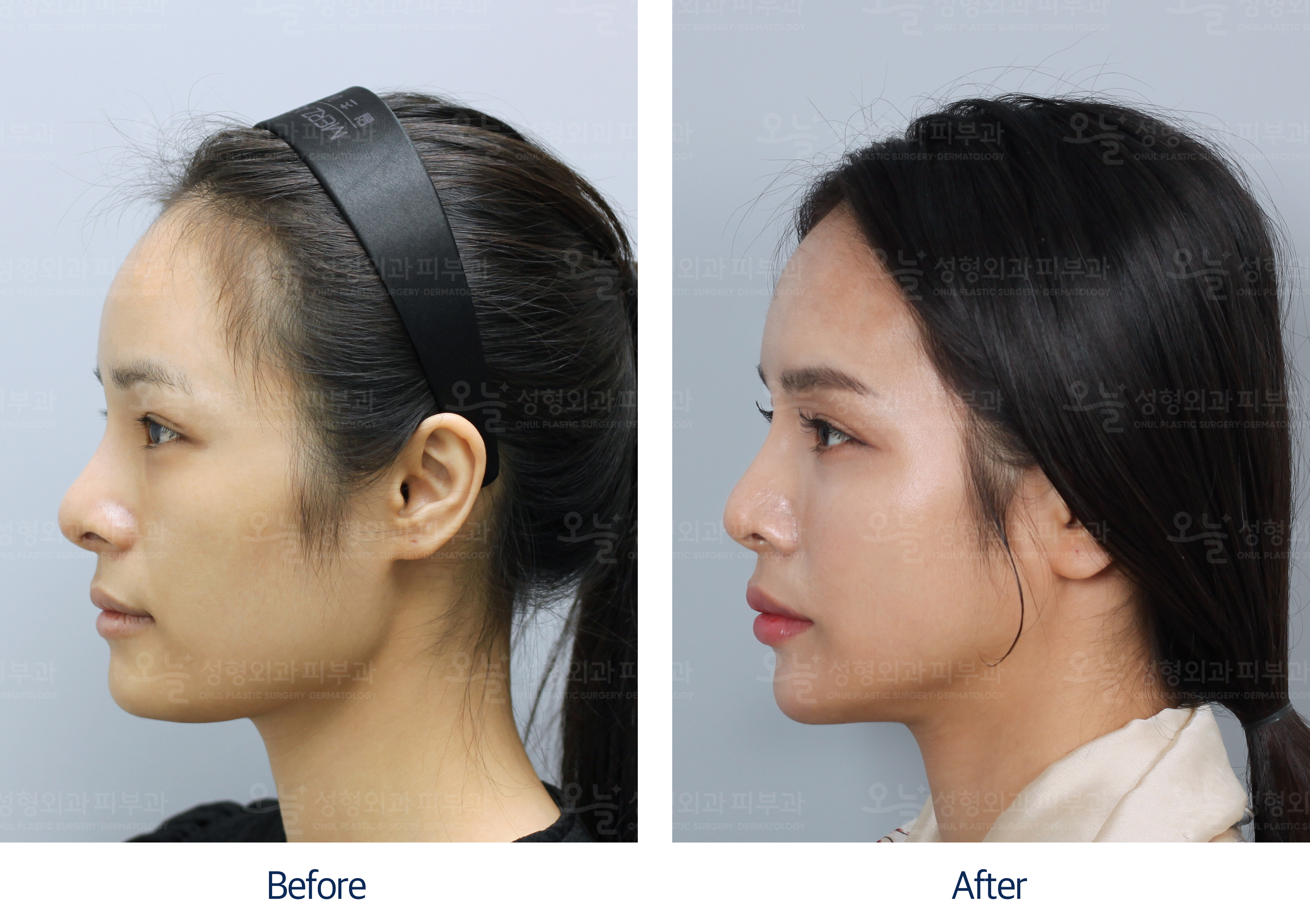 오늘성형외과 전후사진
