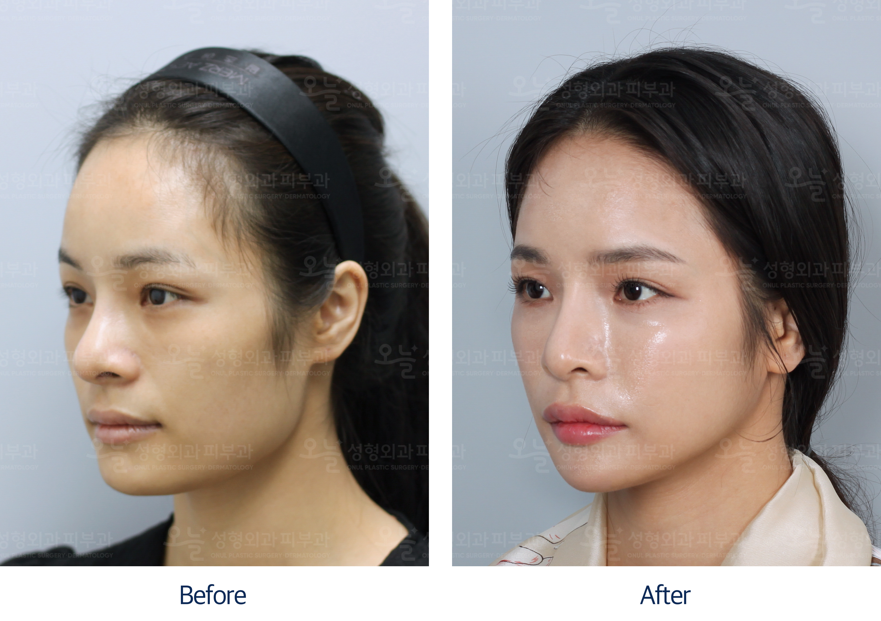 오늘성형외과 전후사진