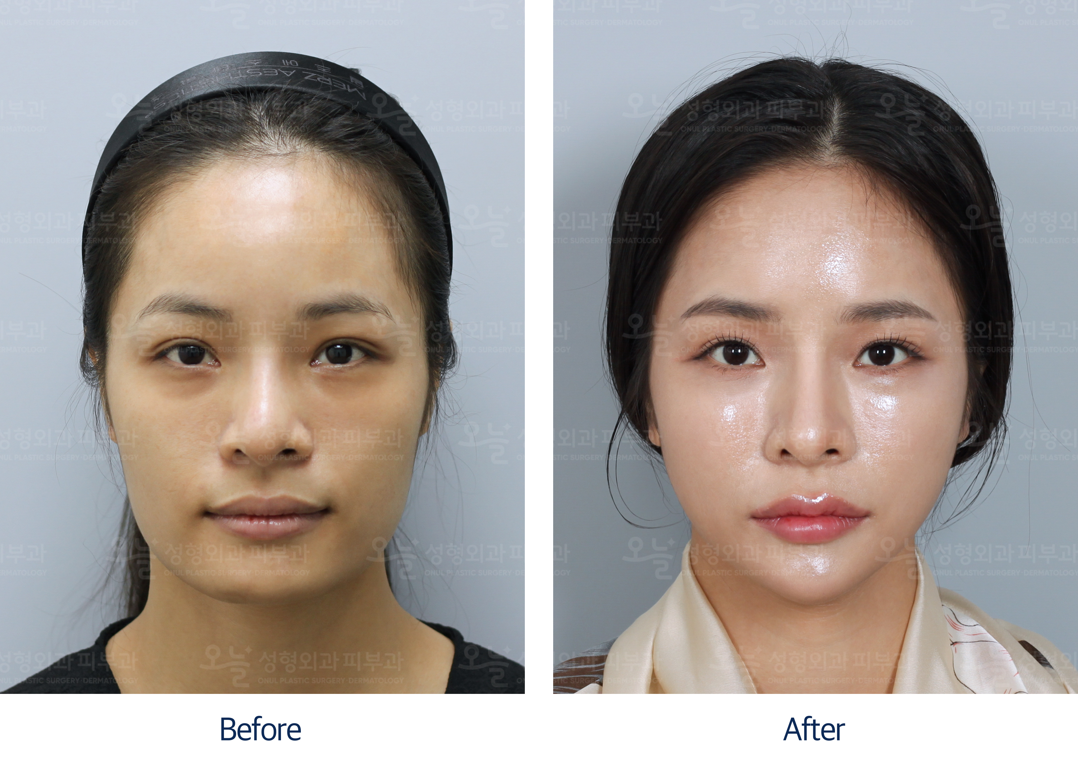 오늘성형외과 전후사진