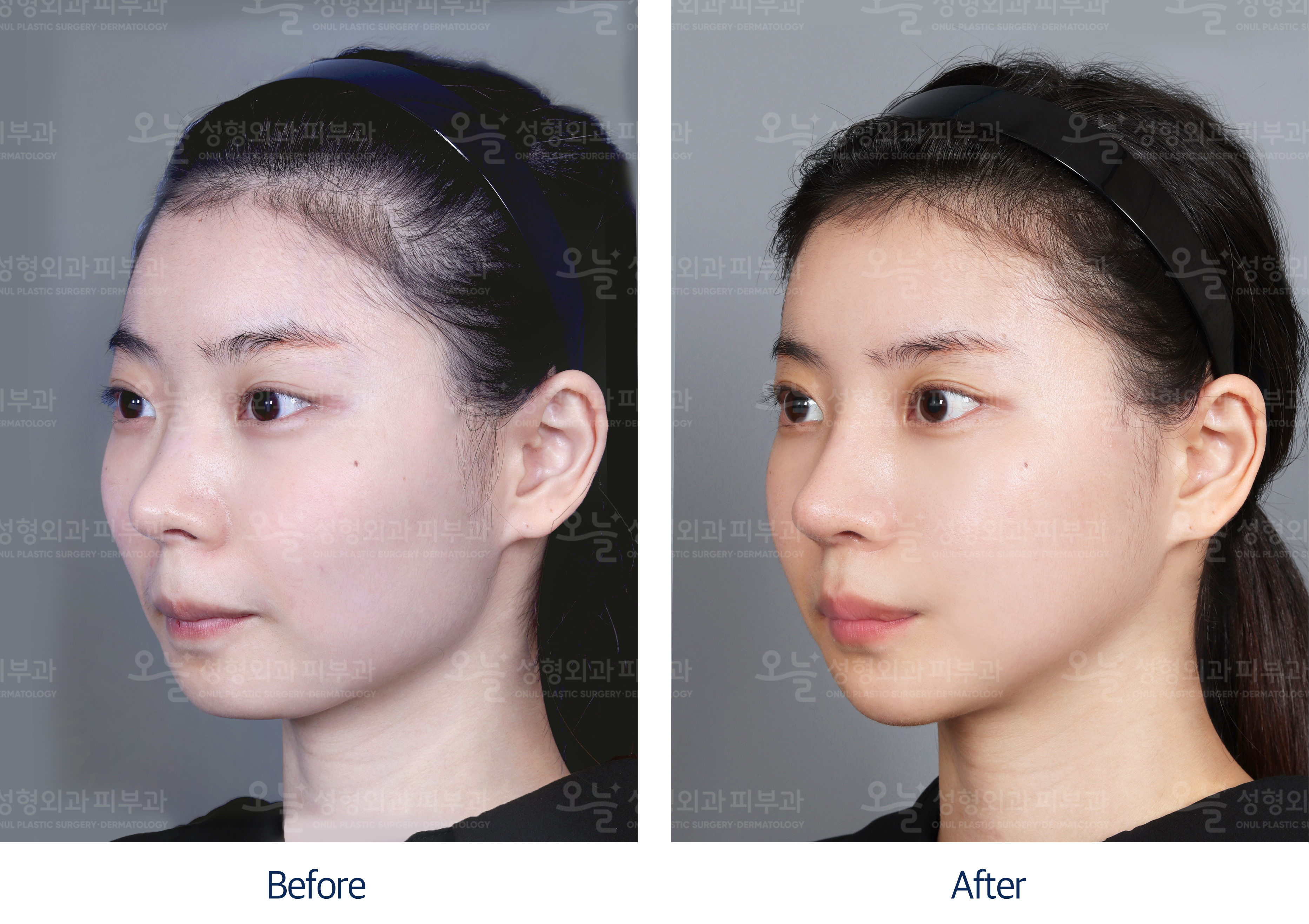 오늘성형외과 전후사진