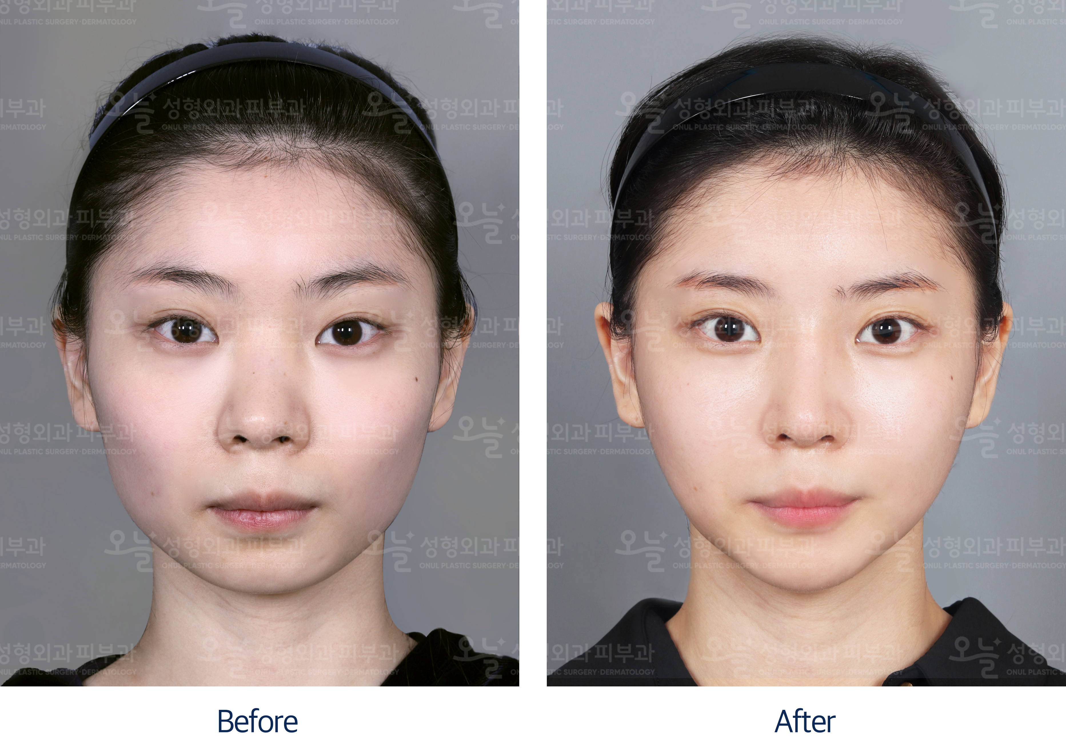 오늘성형외과 전후사진