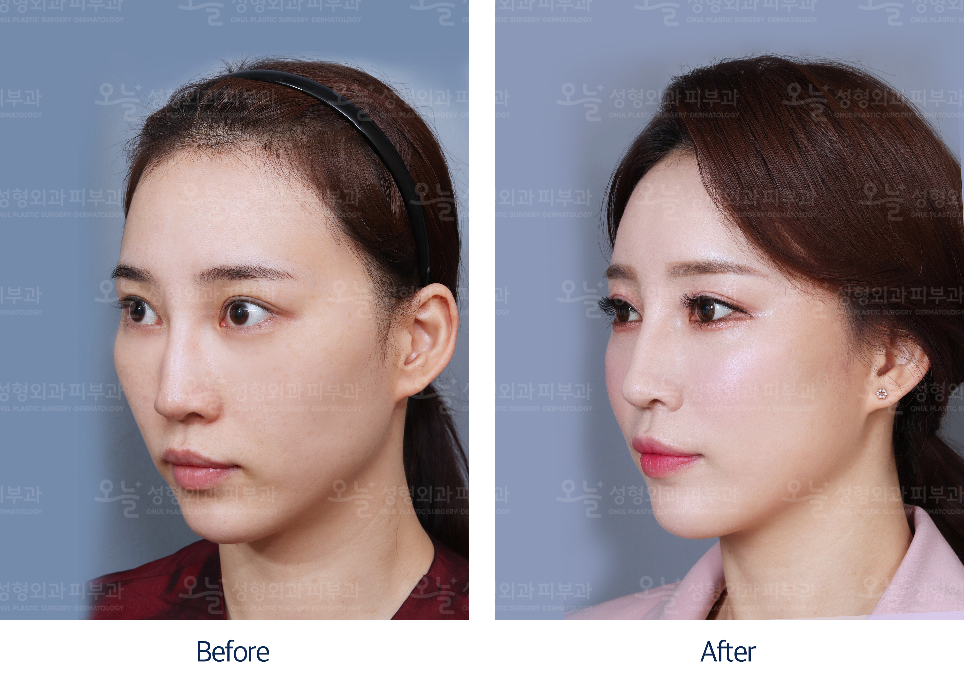 오늘성형외과 전후사진