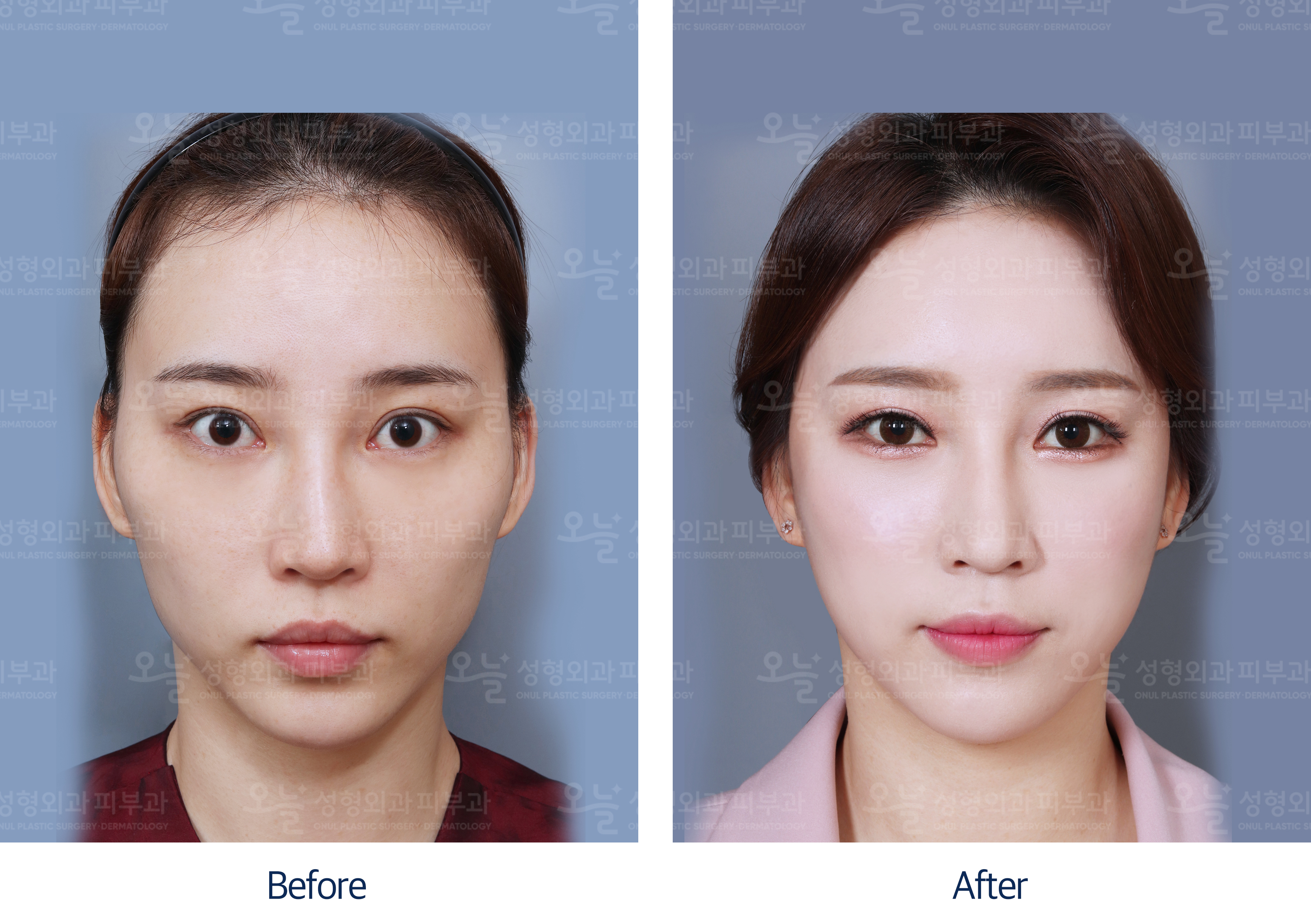 오늘성형외과 전후사진