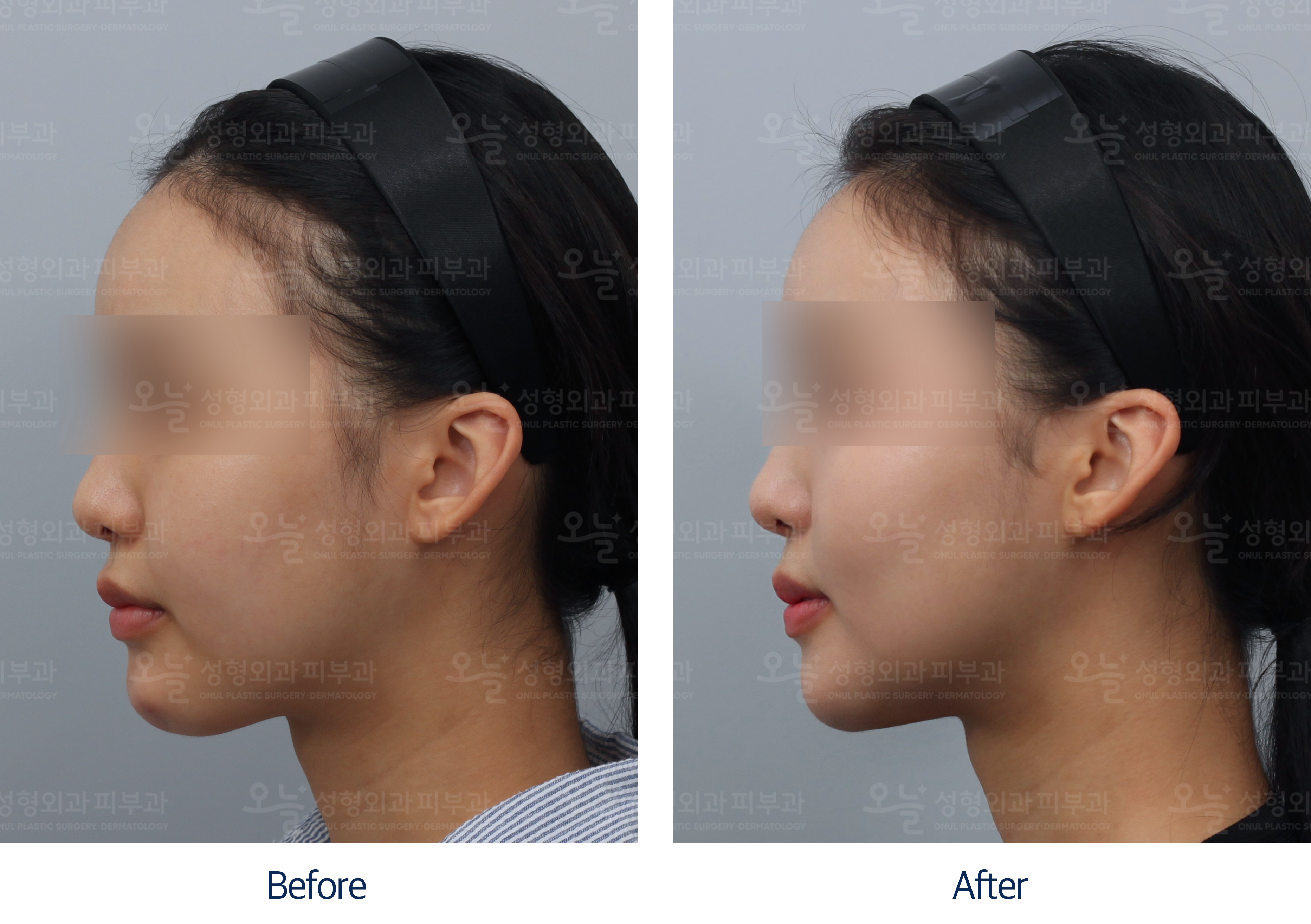 오늘성형외과 전후사진