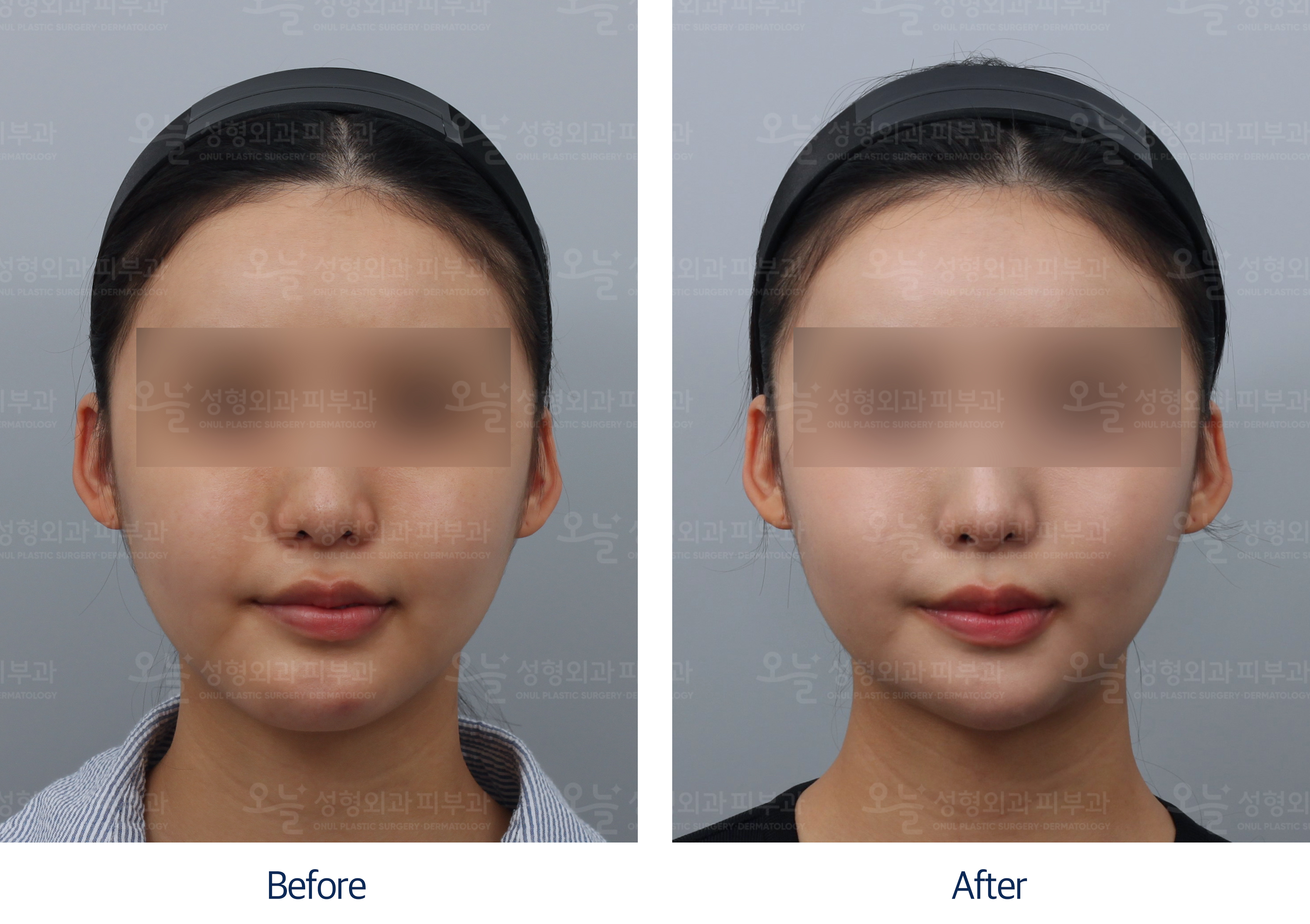 오늘성형외과 전후사진