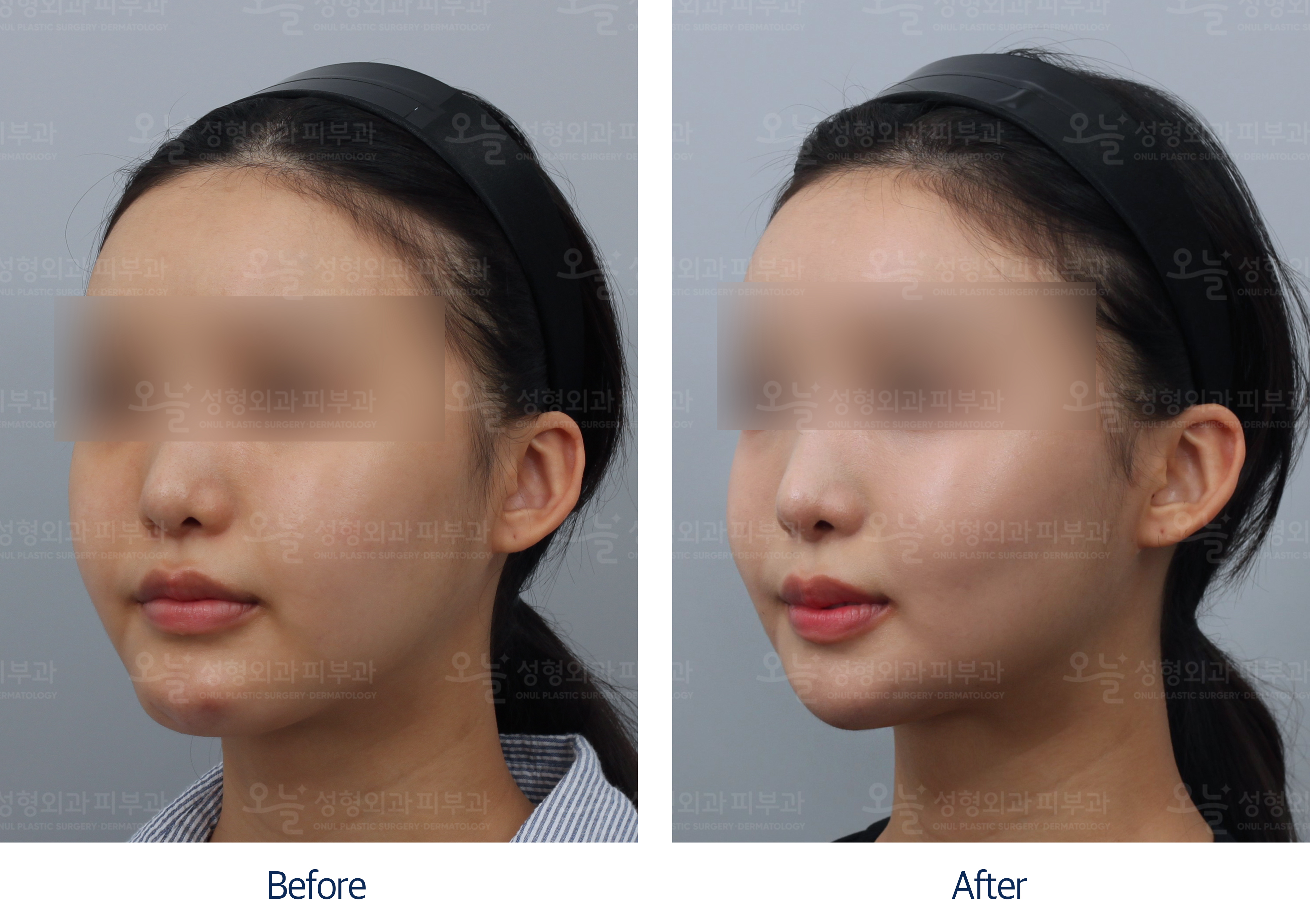 오늘성형외과 전후사진