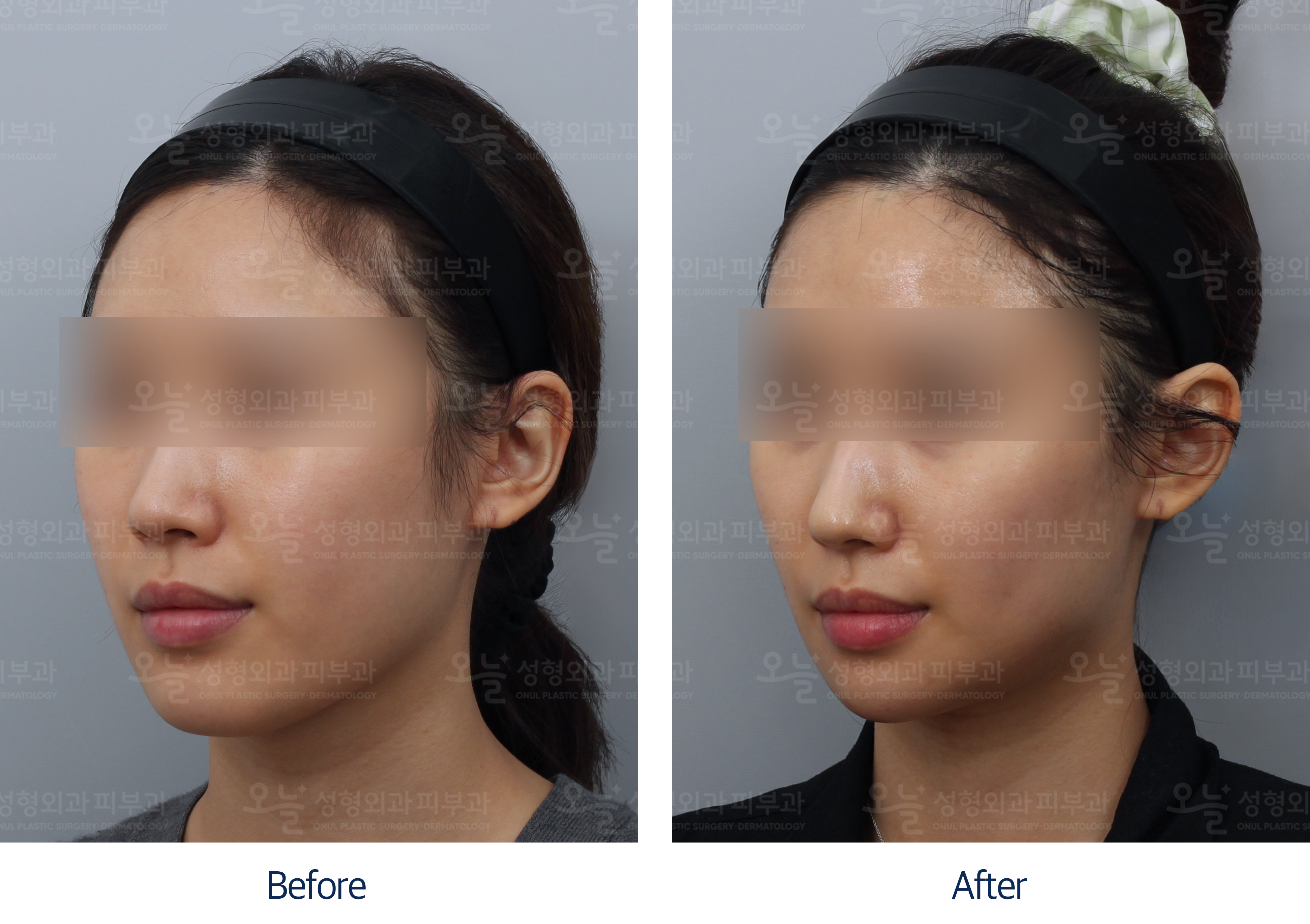오늘성형외과 전후사진