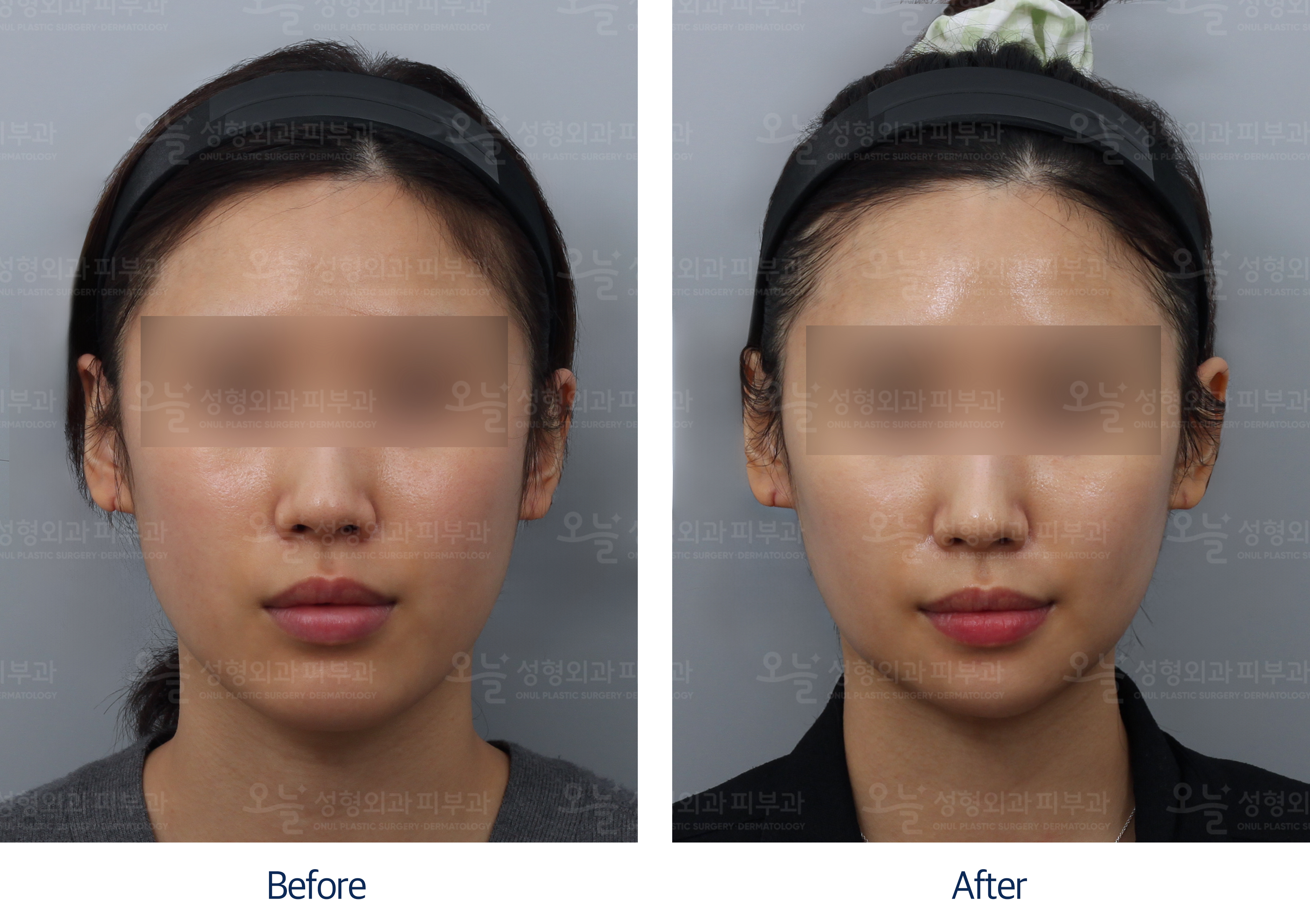 오늘성형외과 전후사진