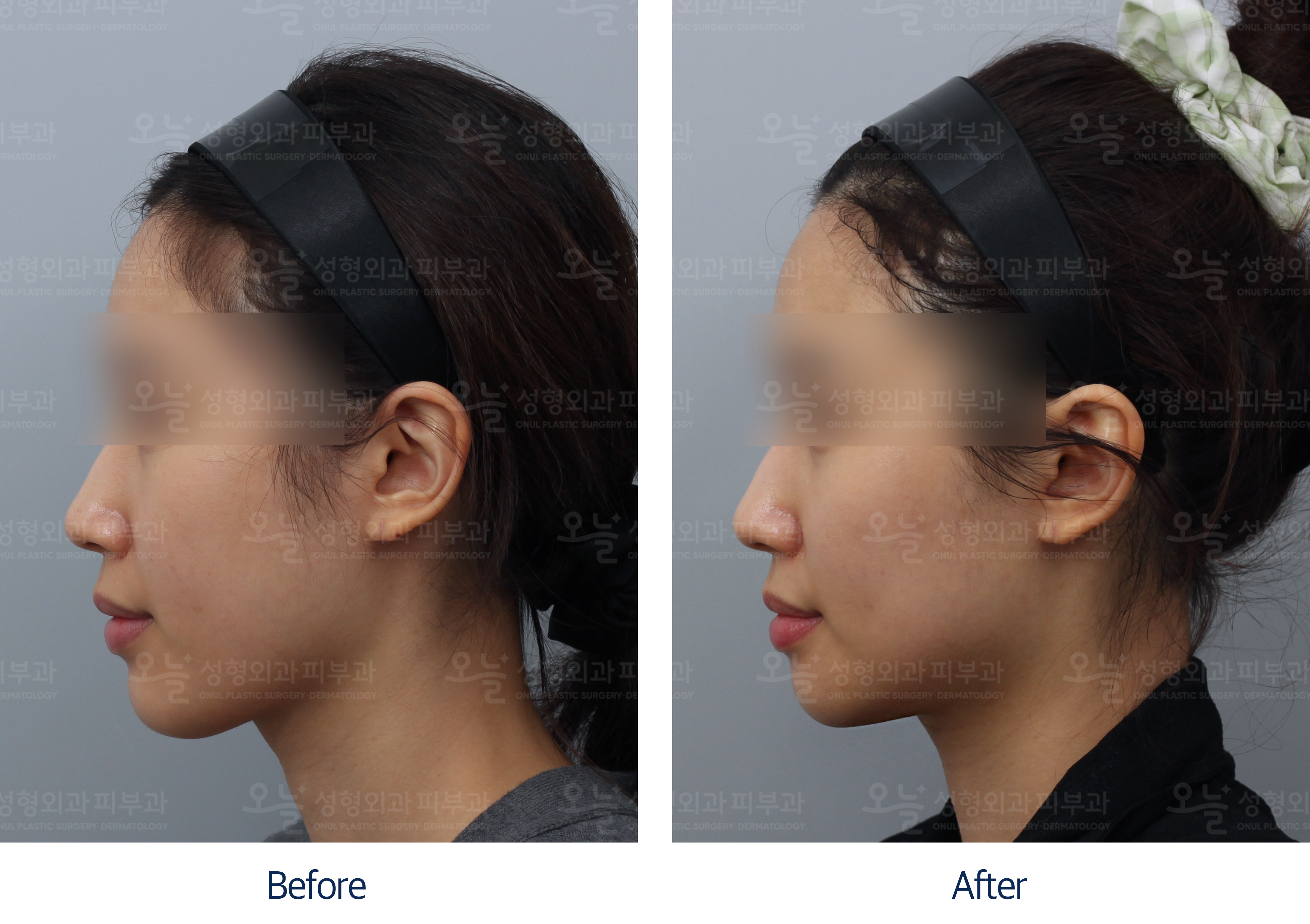 오늘성형외과 전후사진