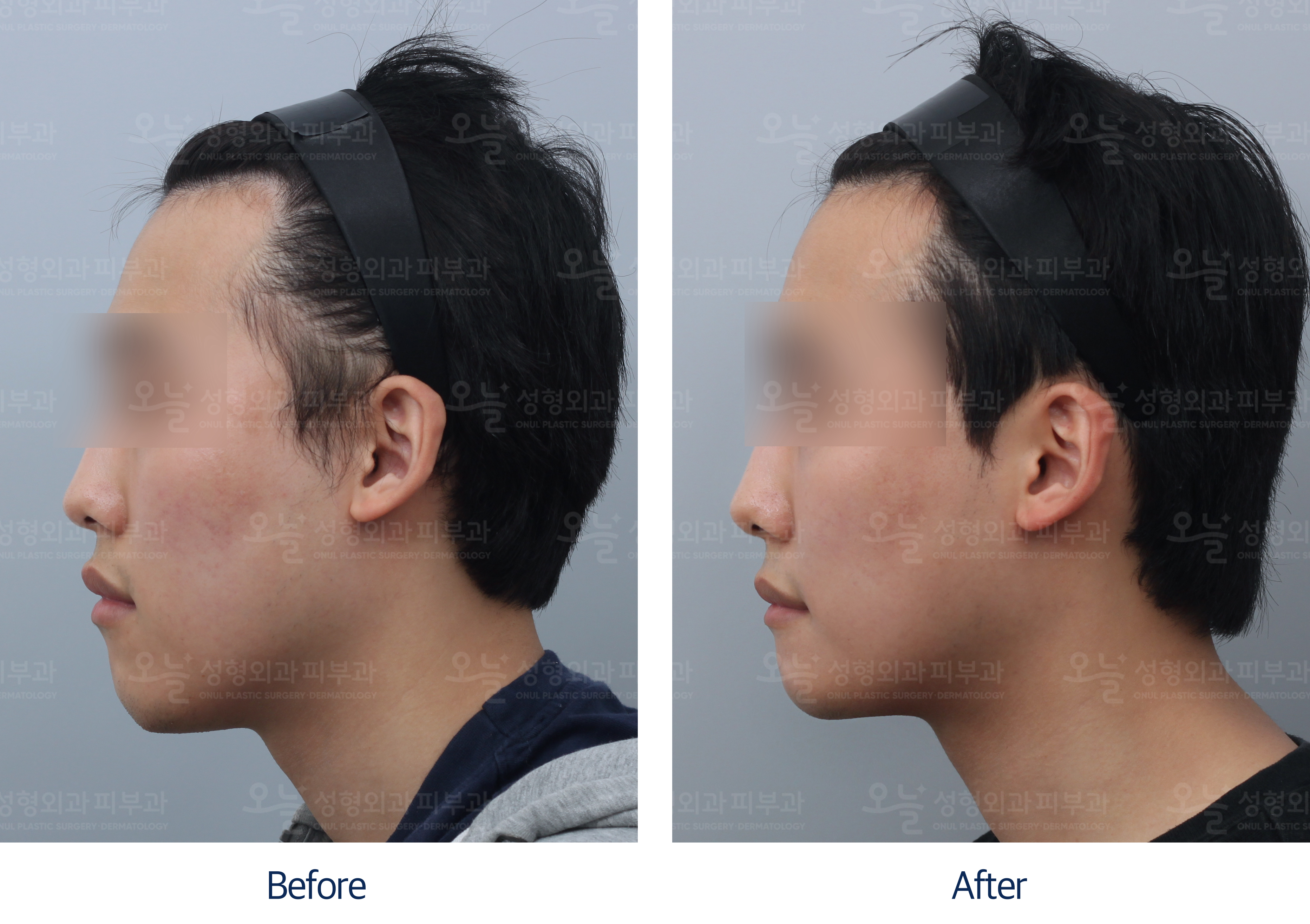 오늘성형외과 전후사진