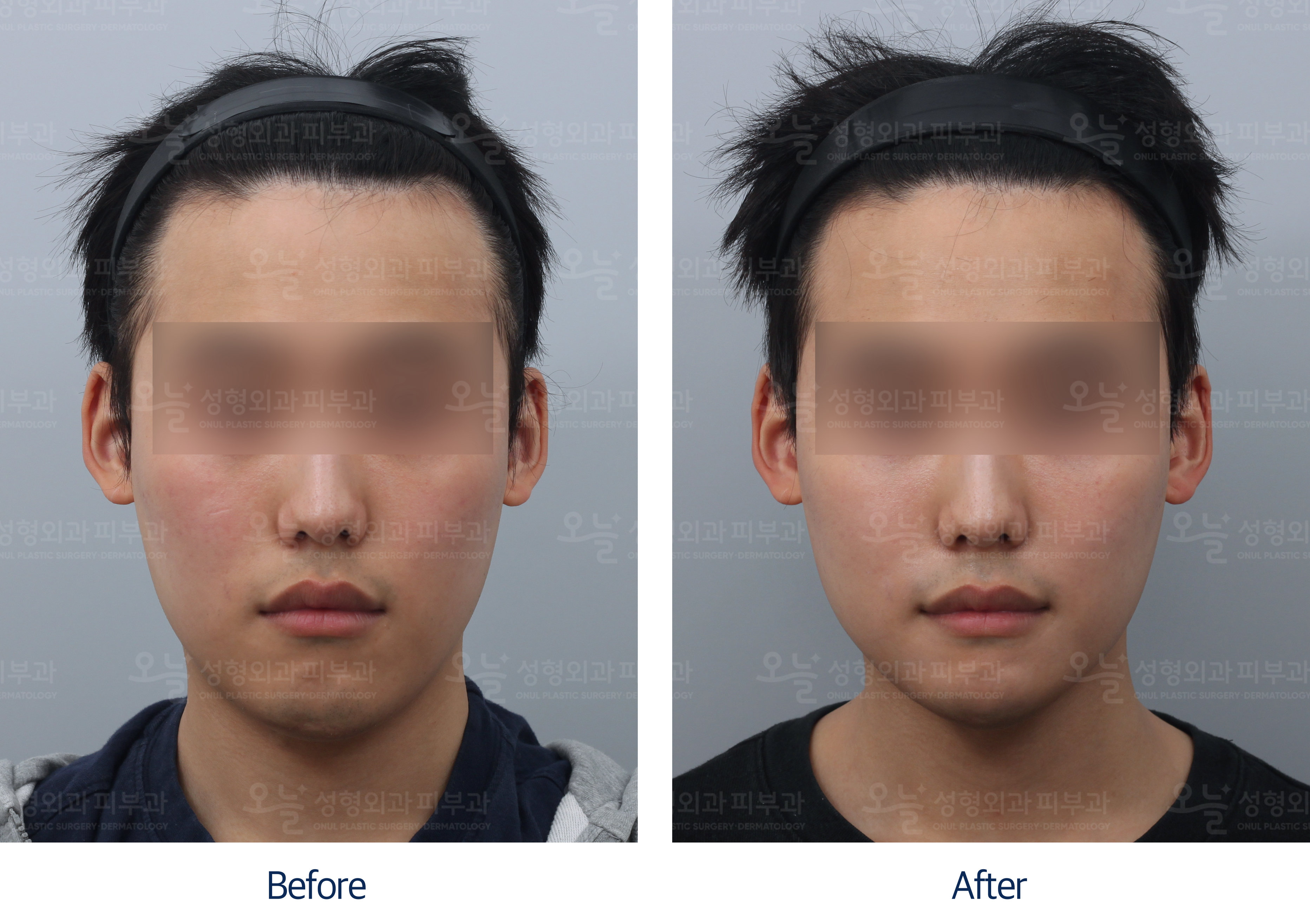 오늘성형외과 전후사진