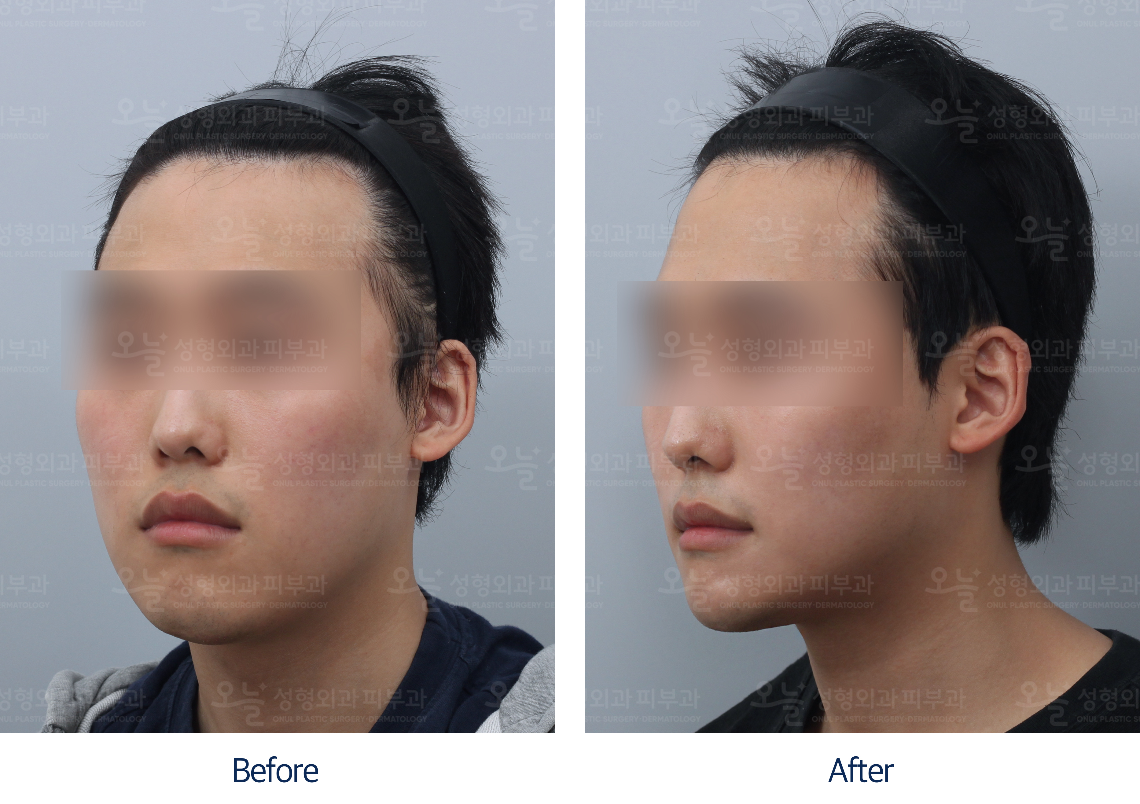 오늘성형외과 전후사진