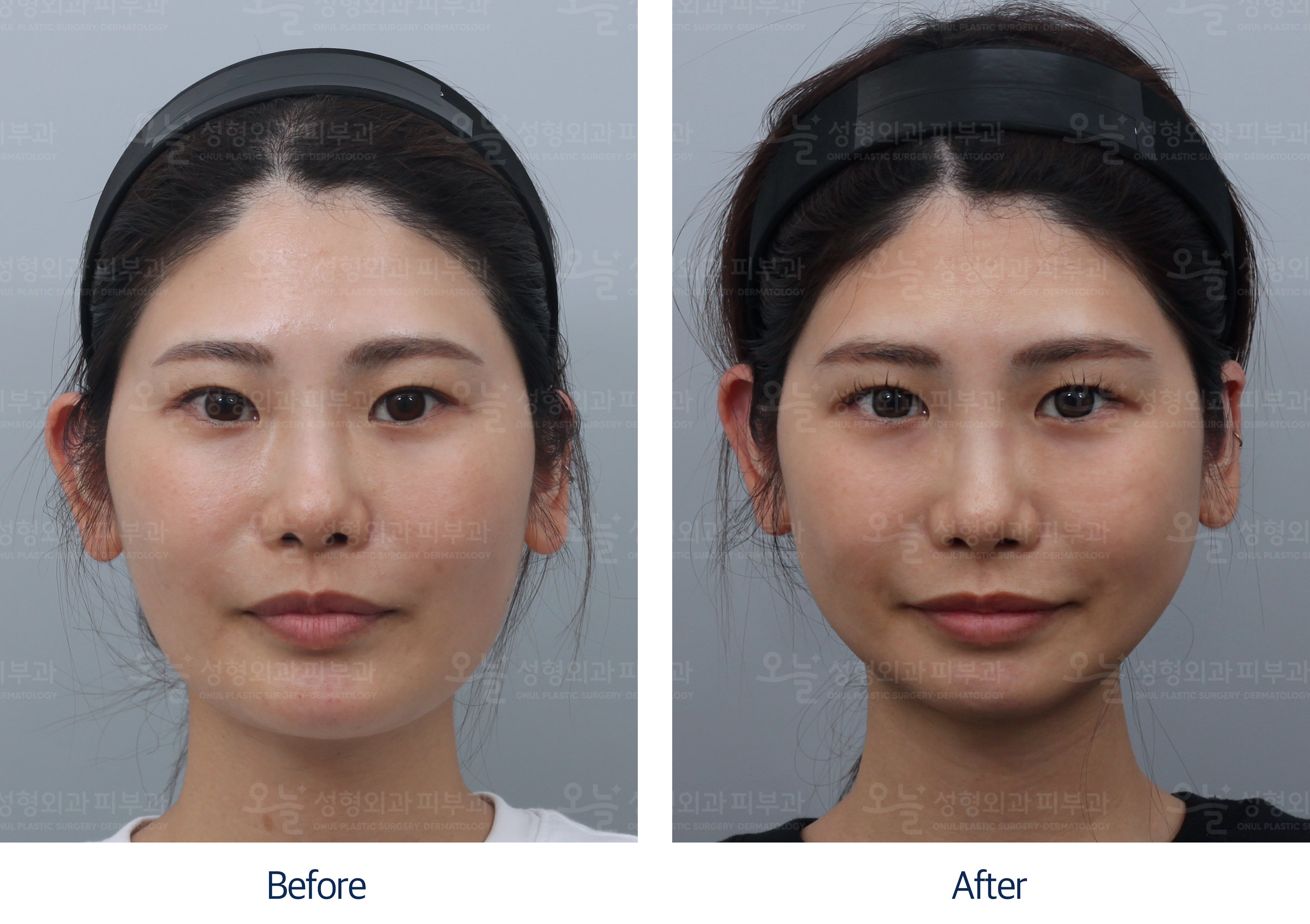 오늘성형외과 전후사진