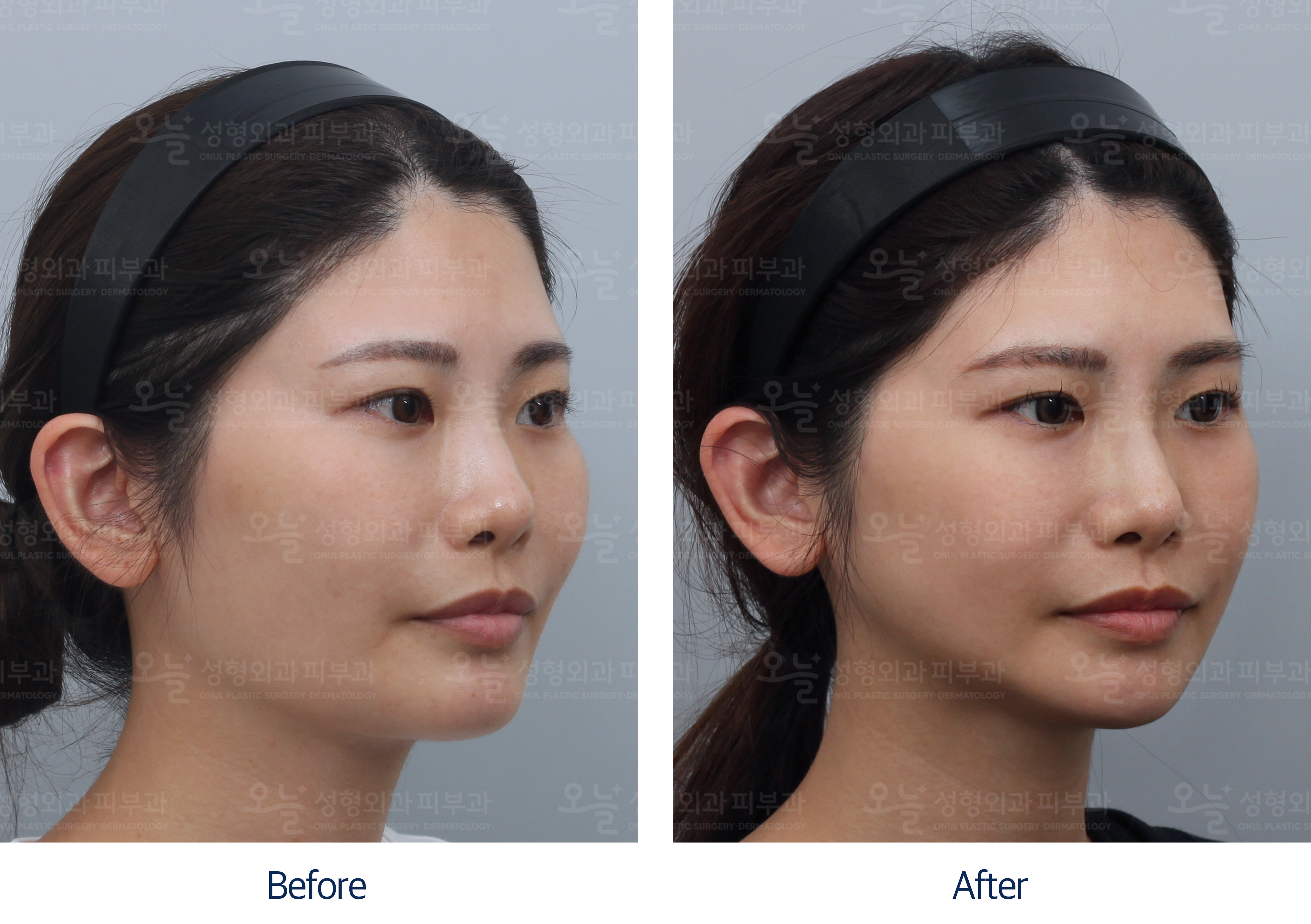 오늘성형외과 전후사진