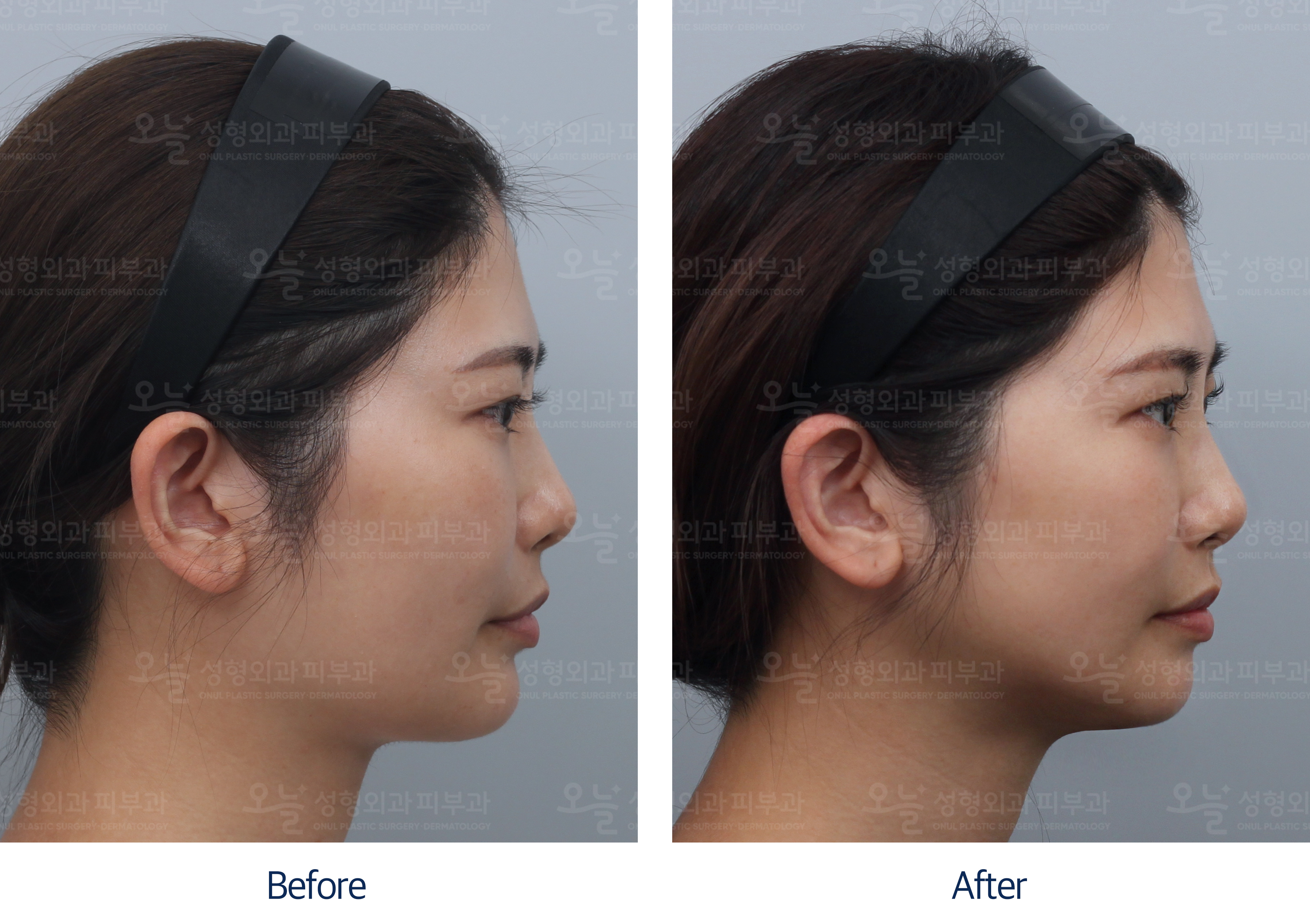 오늘성형외과 전후사진